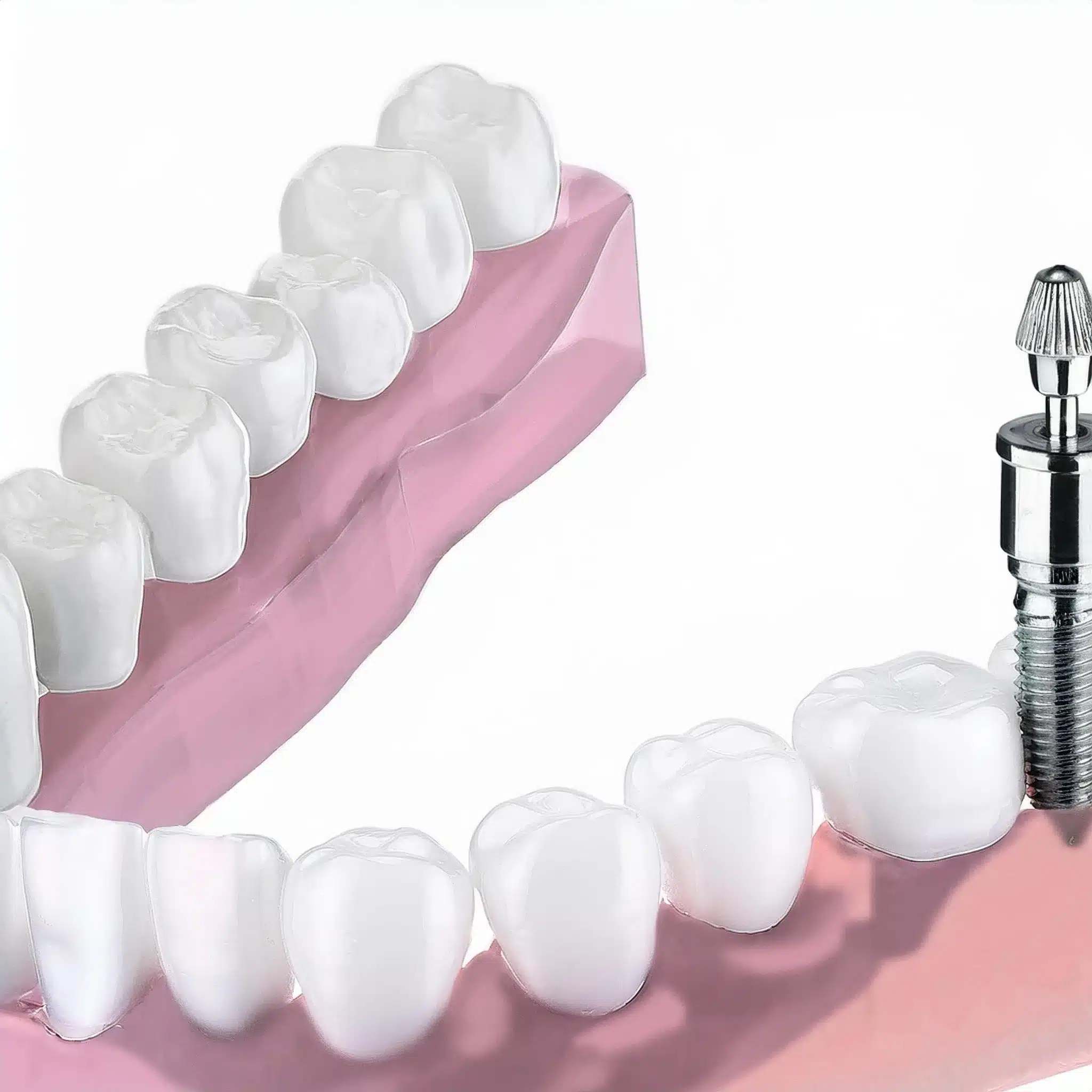 3D plan of dental implants