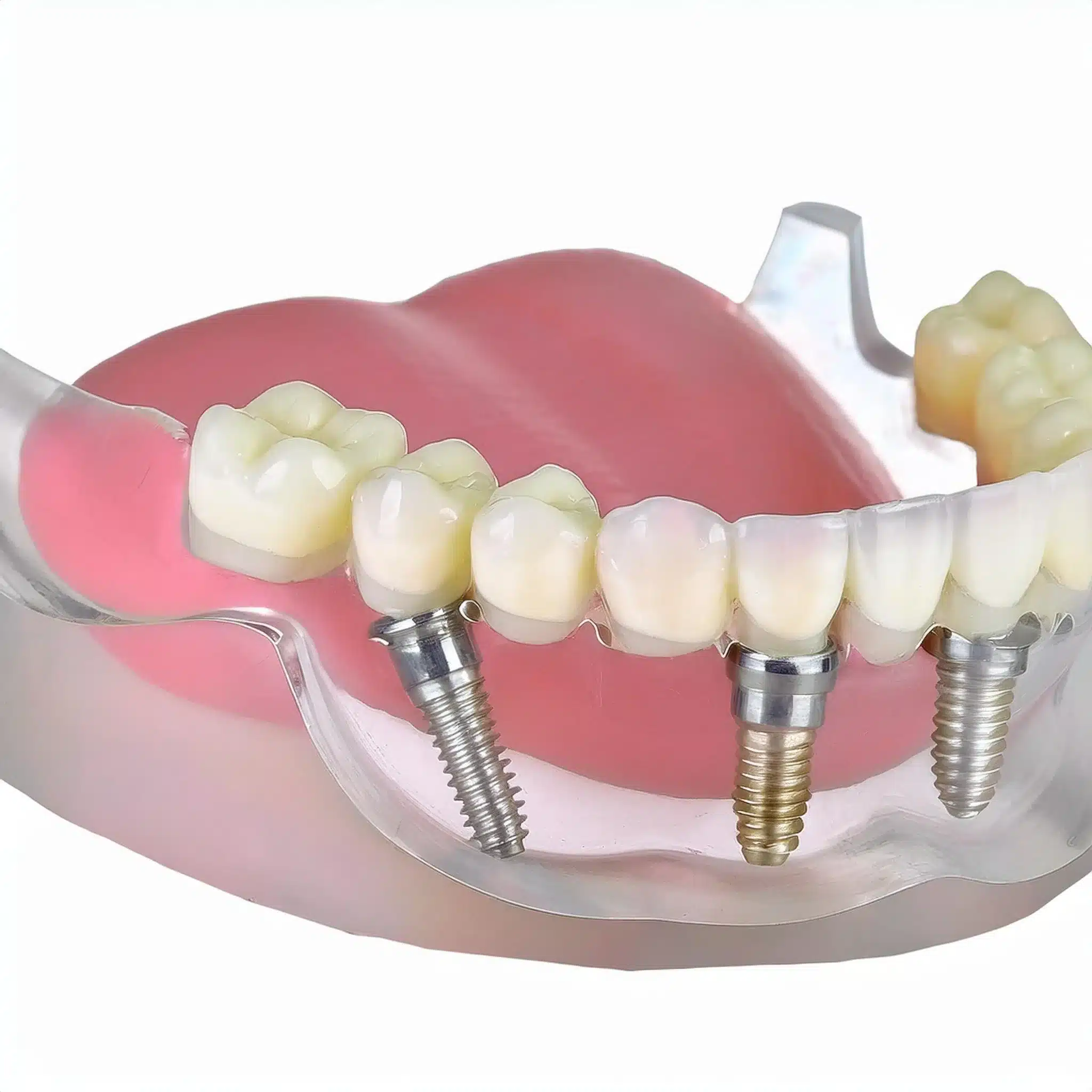 3D plan of dental implants