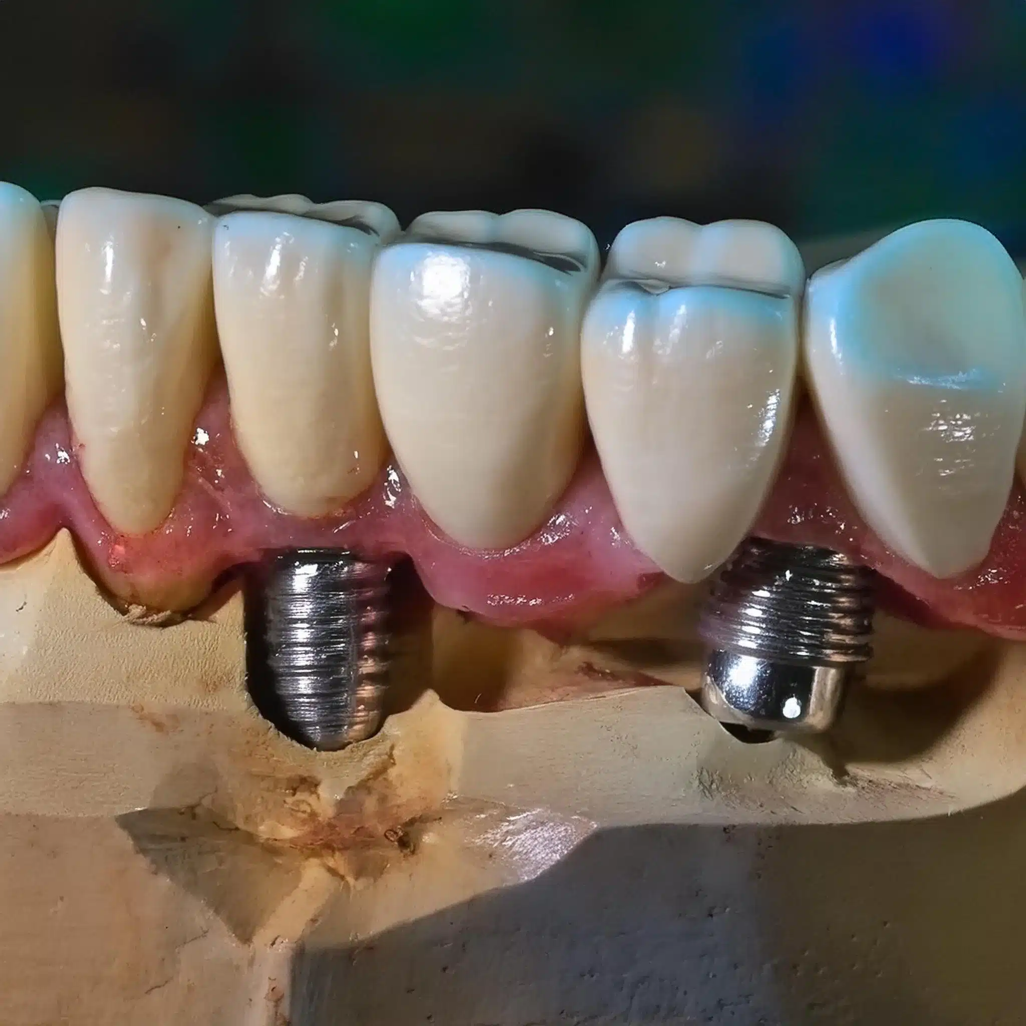 dental implants