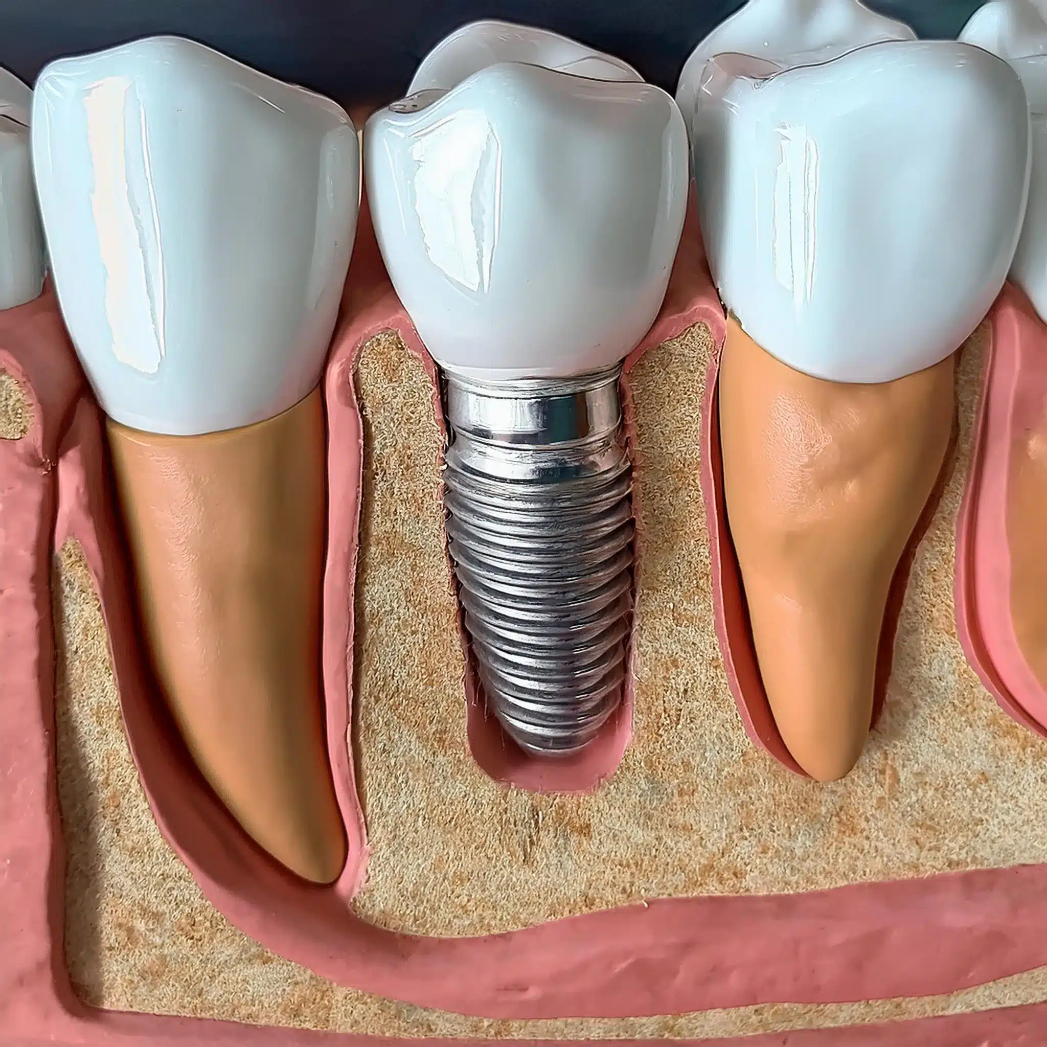 Impianto dentale Xenograft