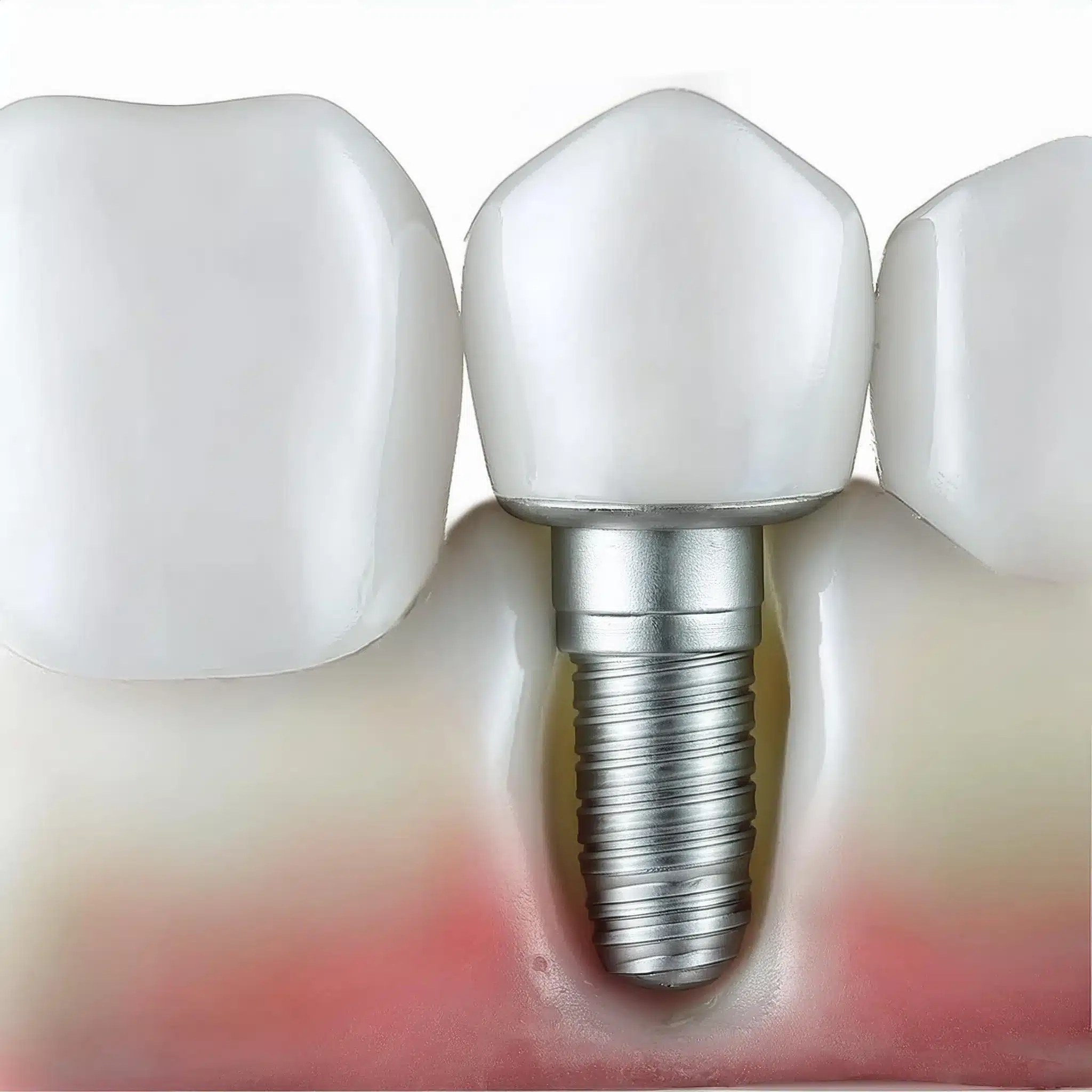 L'inserimento di impianti dentali per un singolo dente