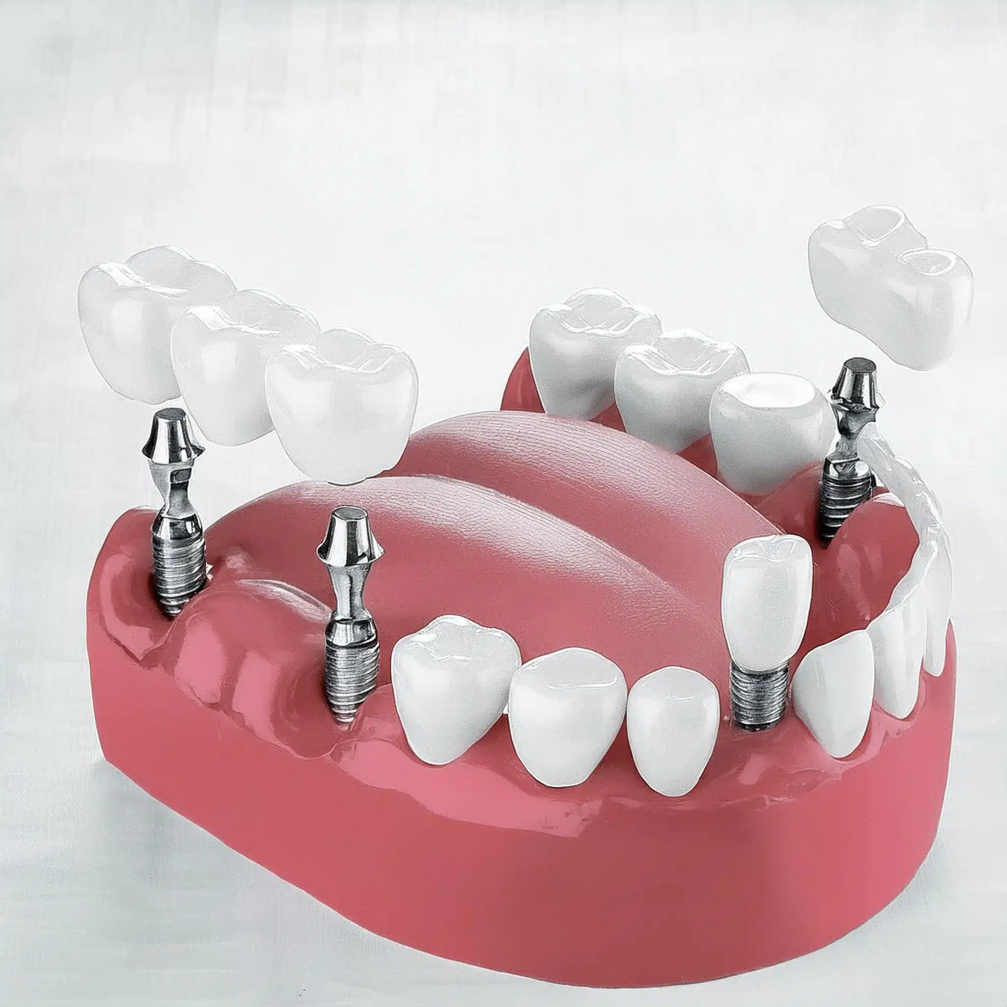 Multiple dental implants