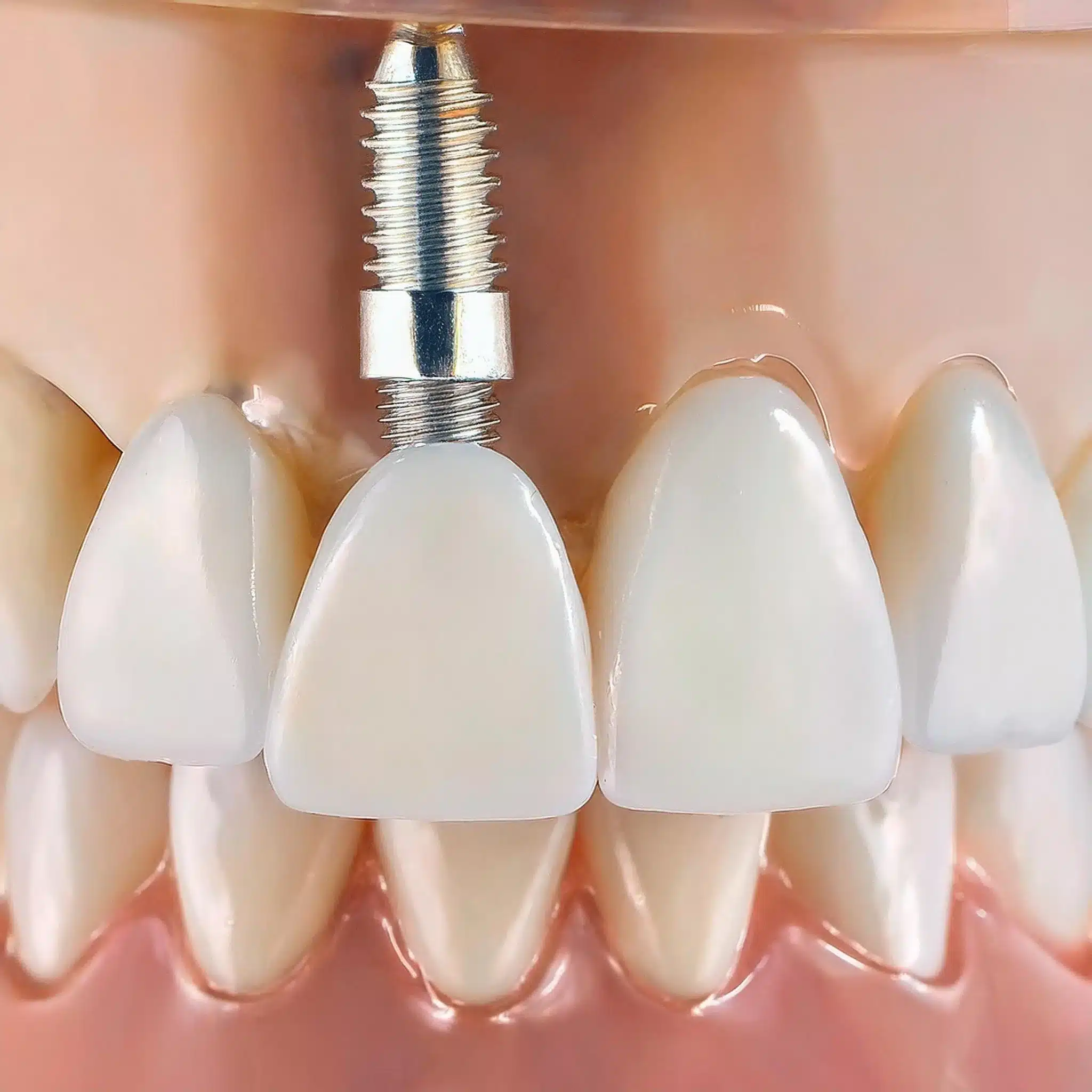 Dental implant benefits