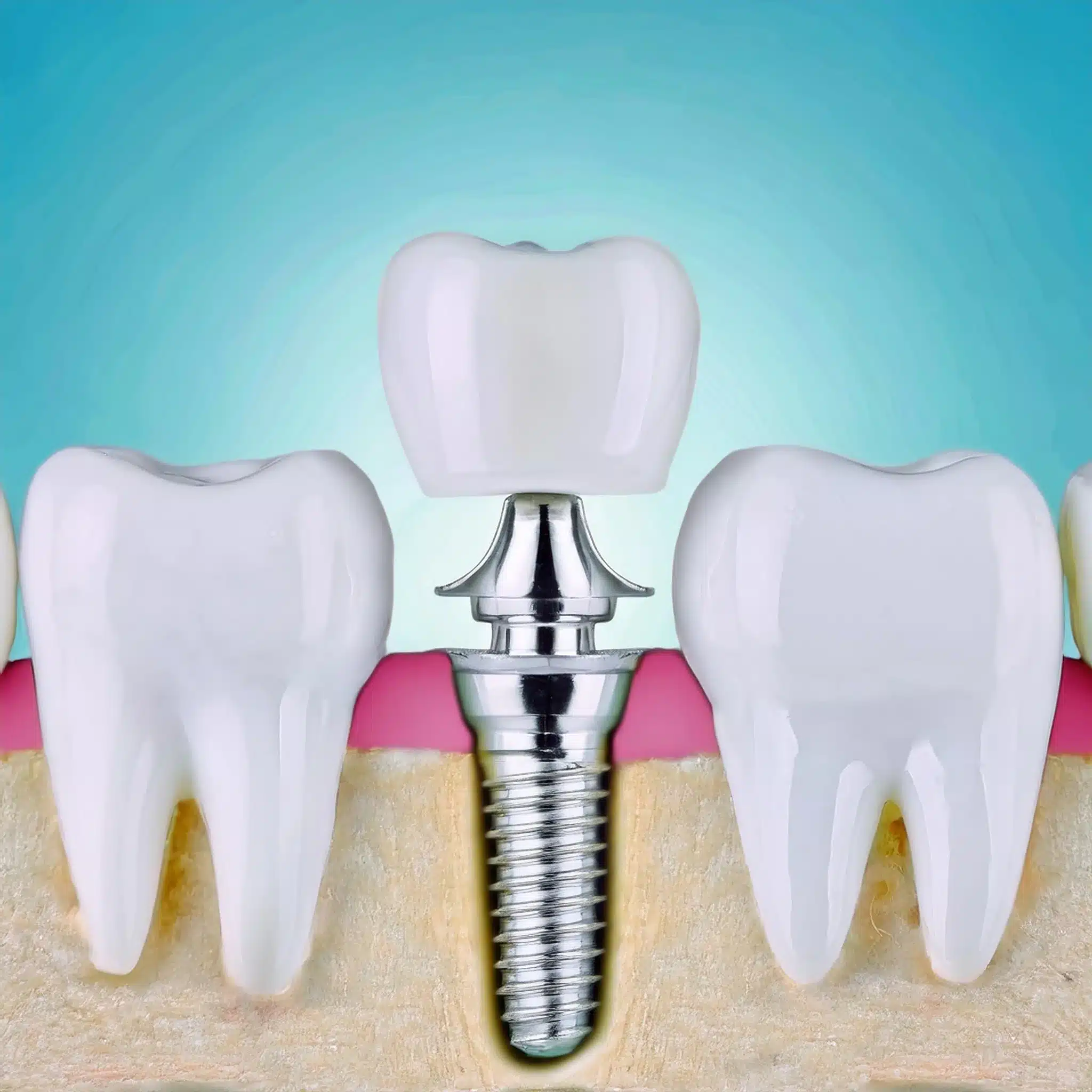 How is a dental implant placement