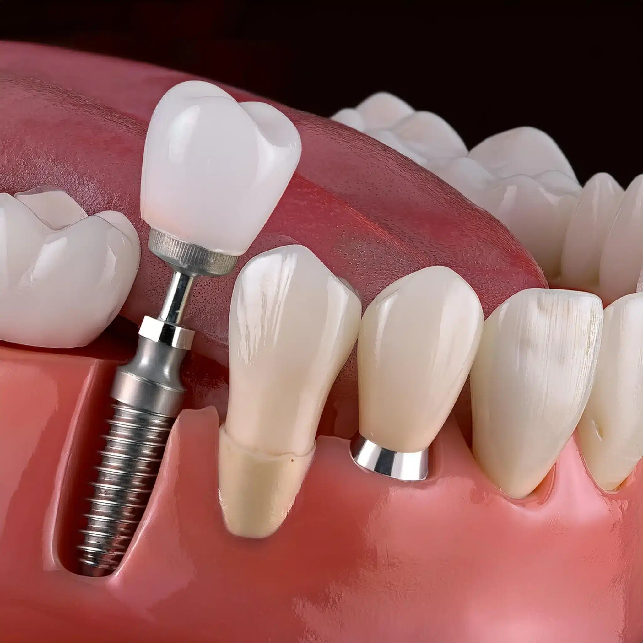 3d plan of delayed loading dental implants