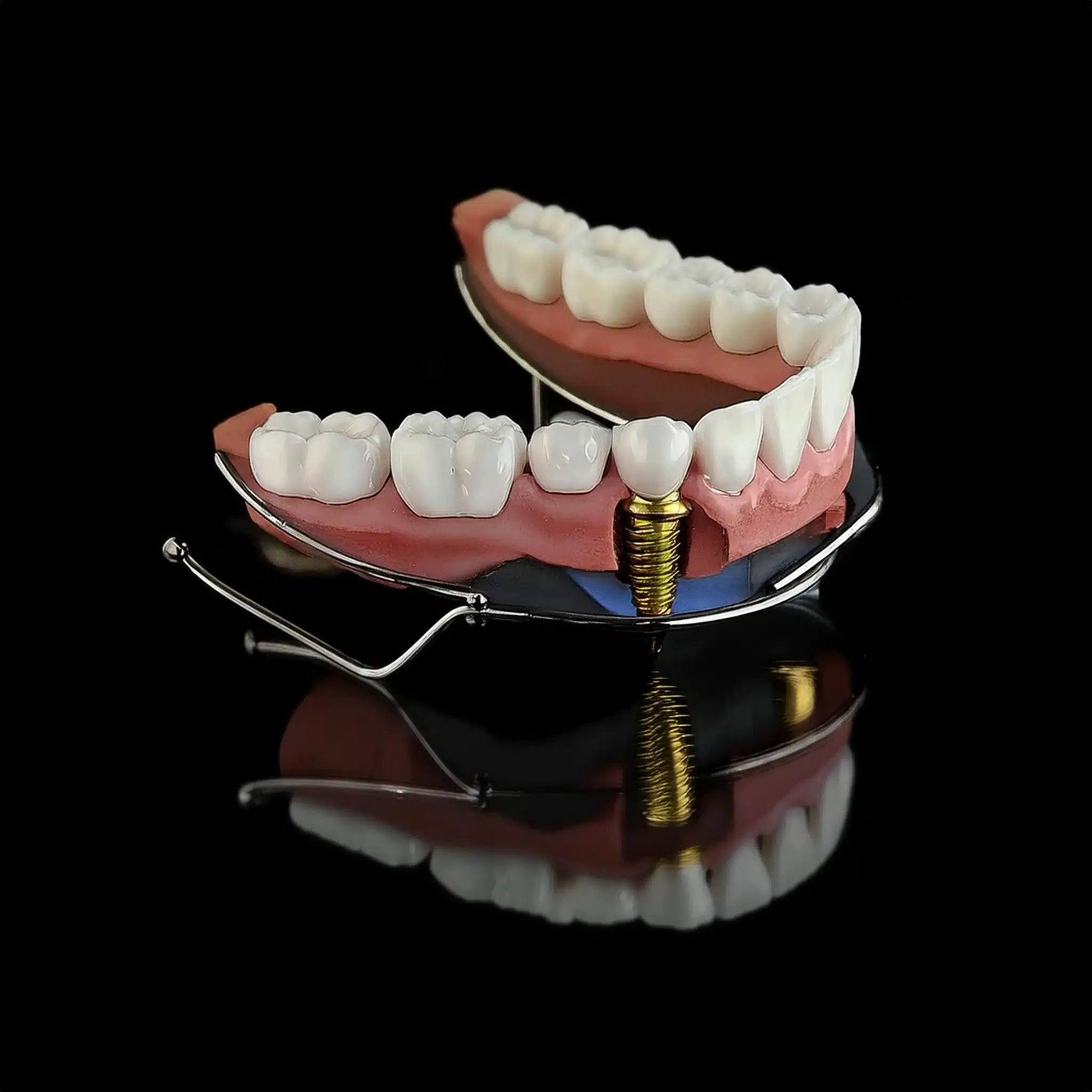 How is placement a subperiosteal dental implant?