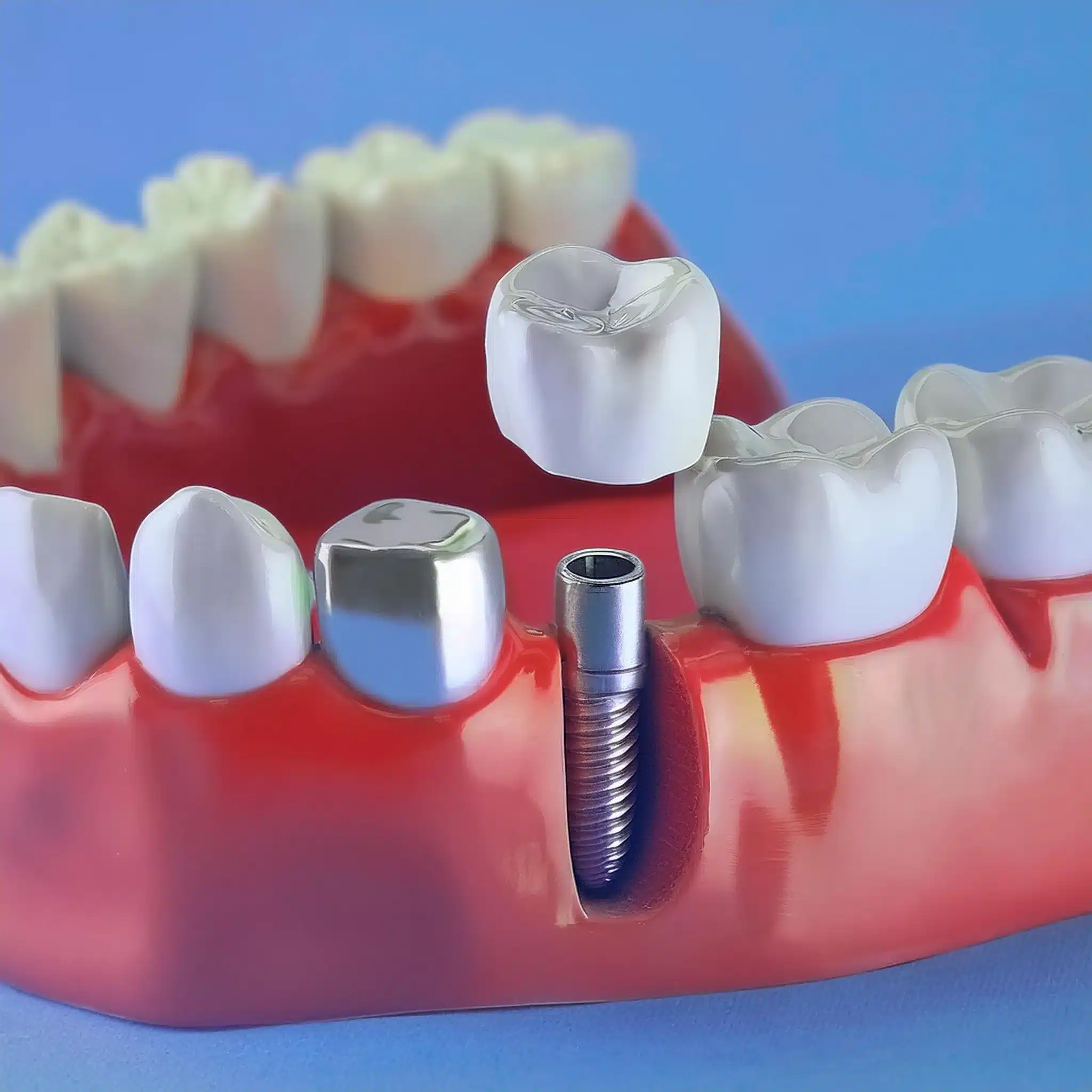 Impianti dentali ad osteointergrazione