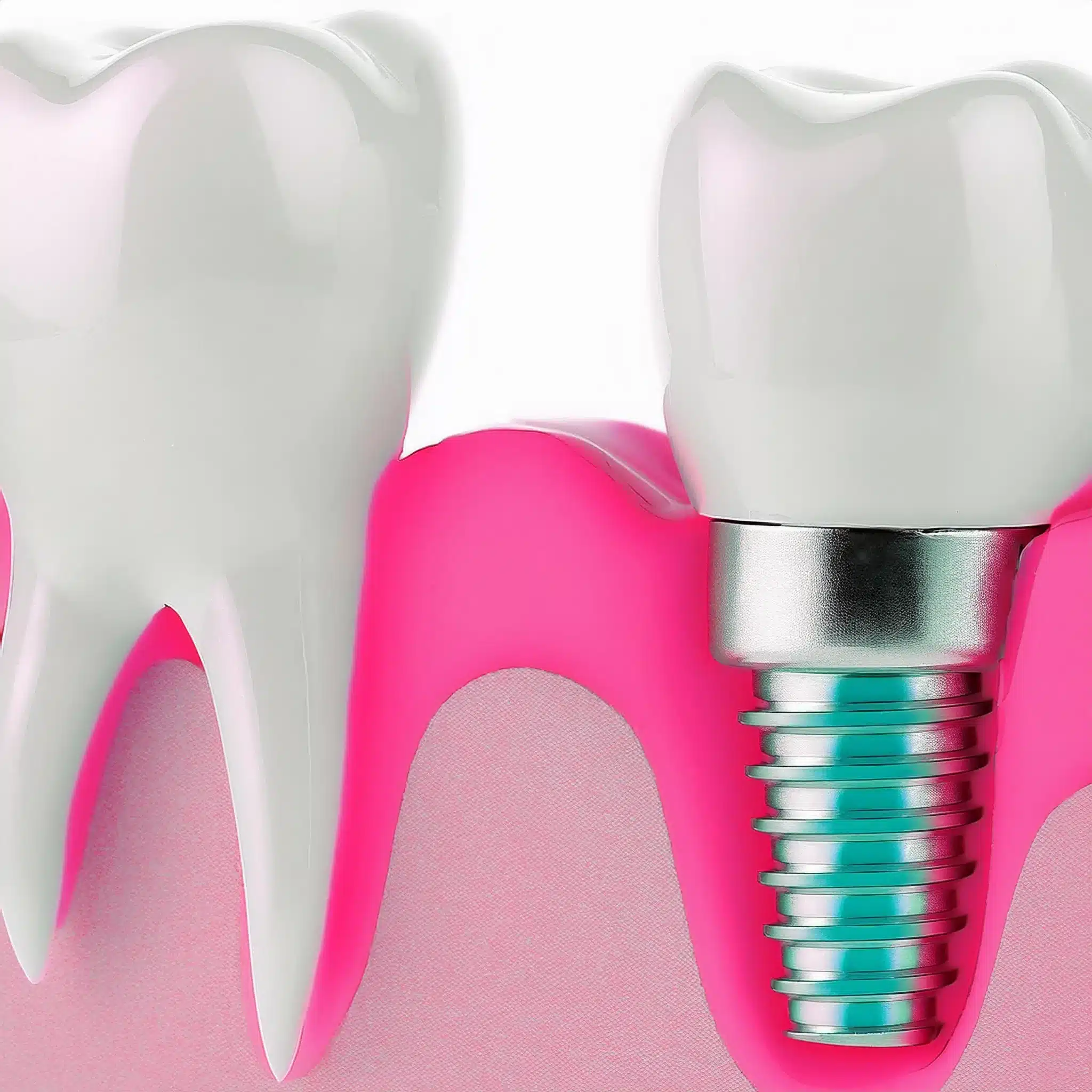 The placement of dental implants