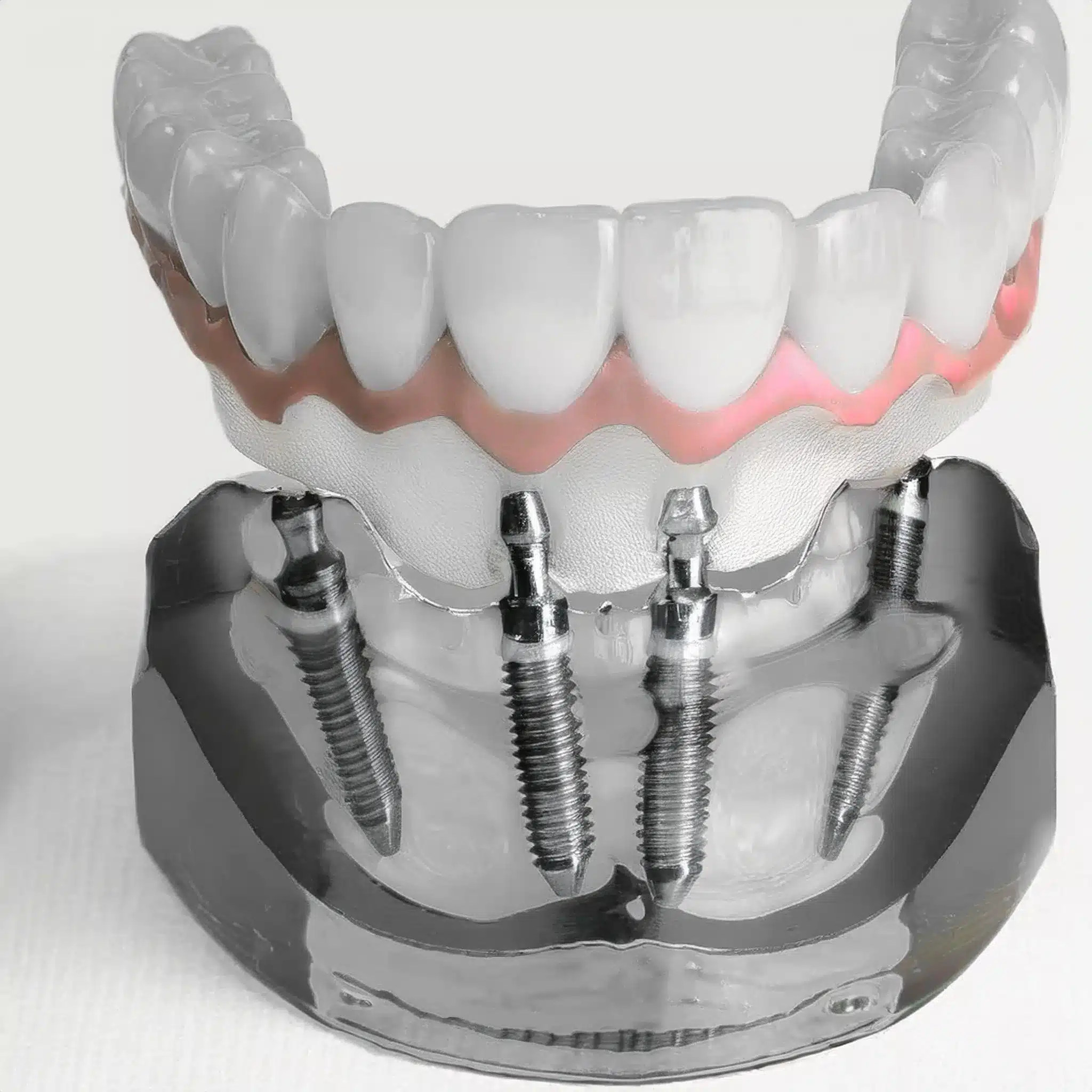 Work of full arch dental implants