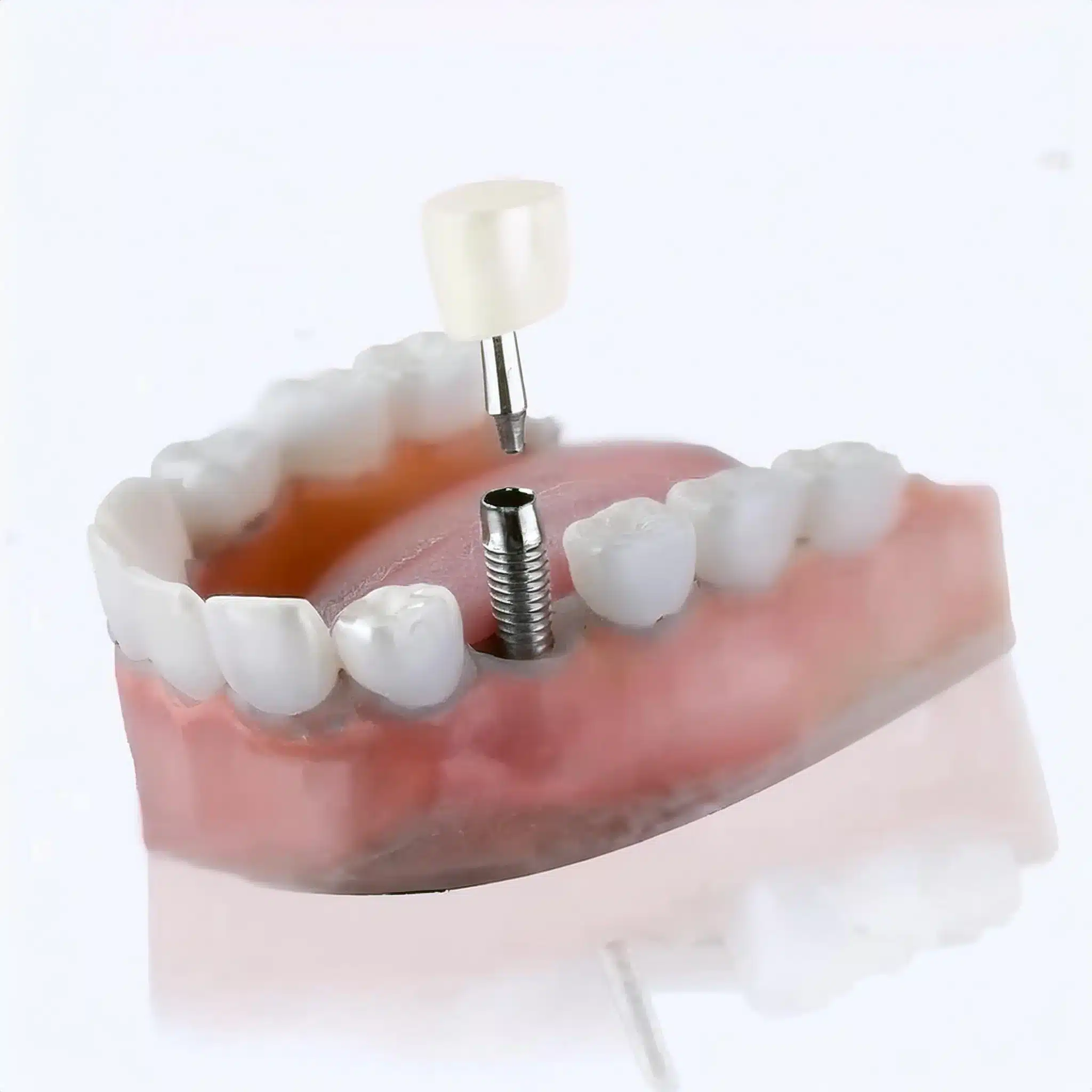 3D plan of dental implants