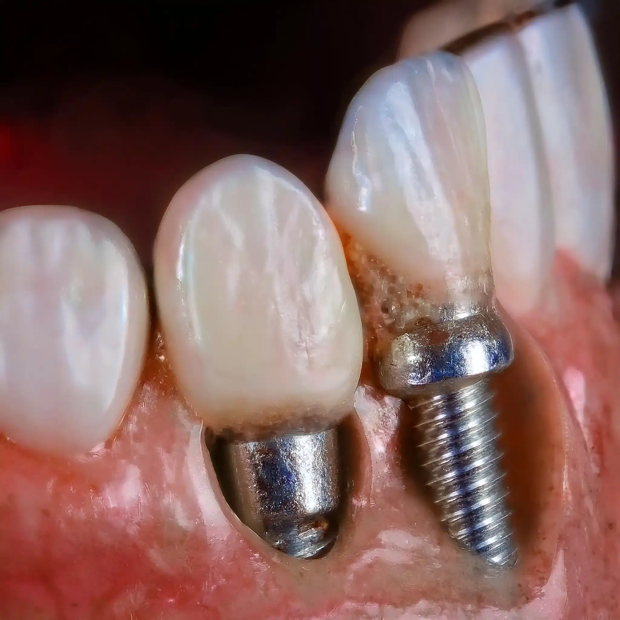 Dental implant failure