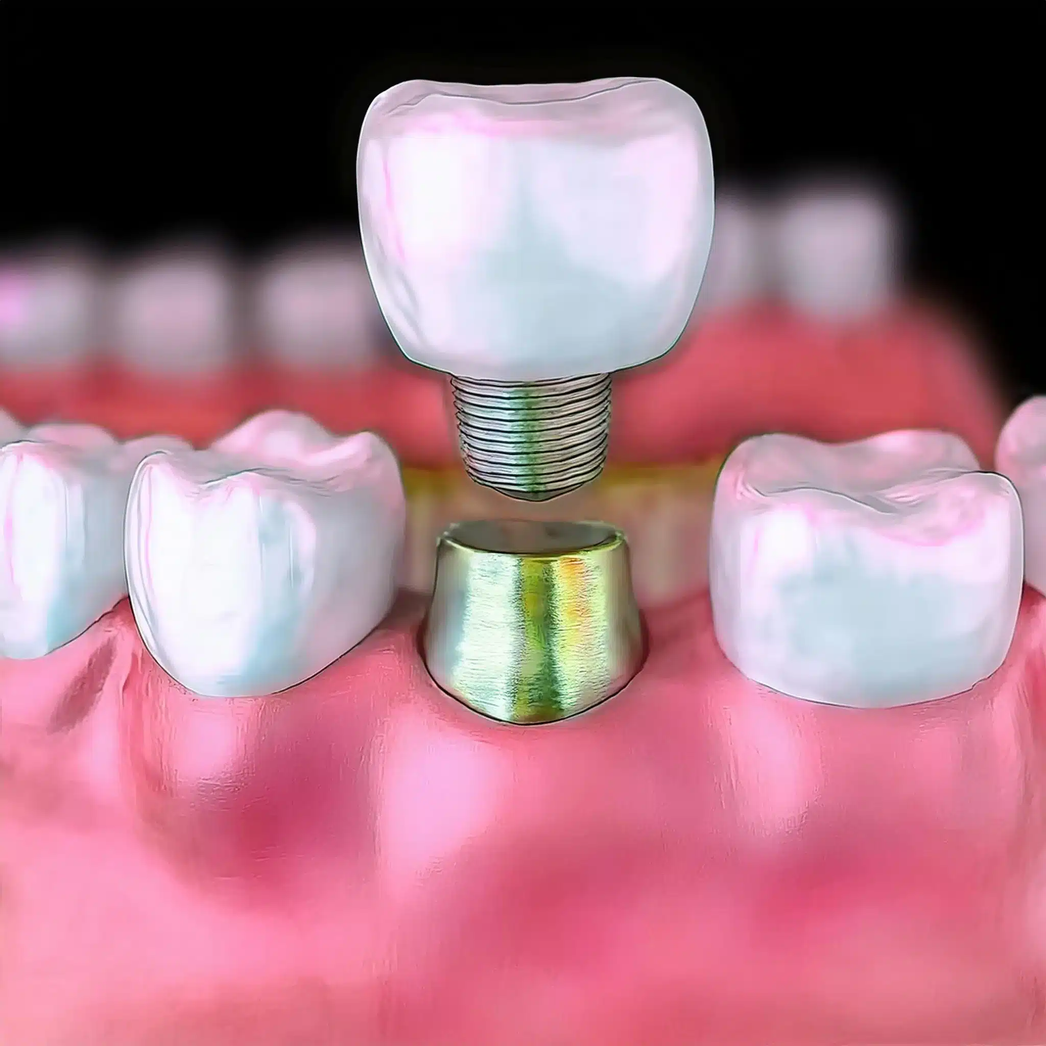 Dental implant