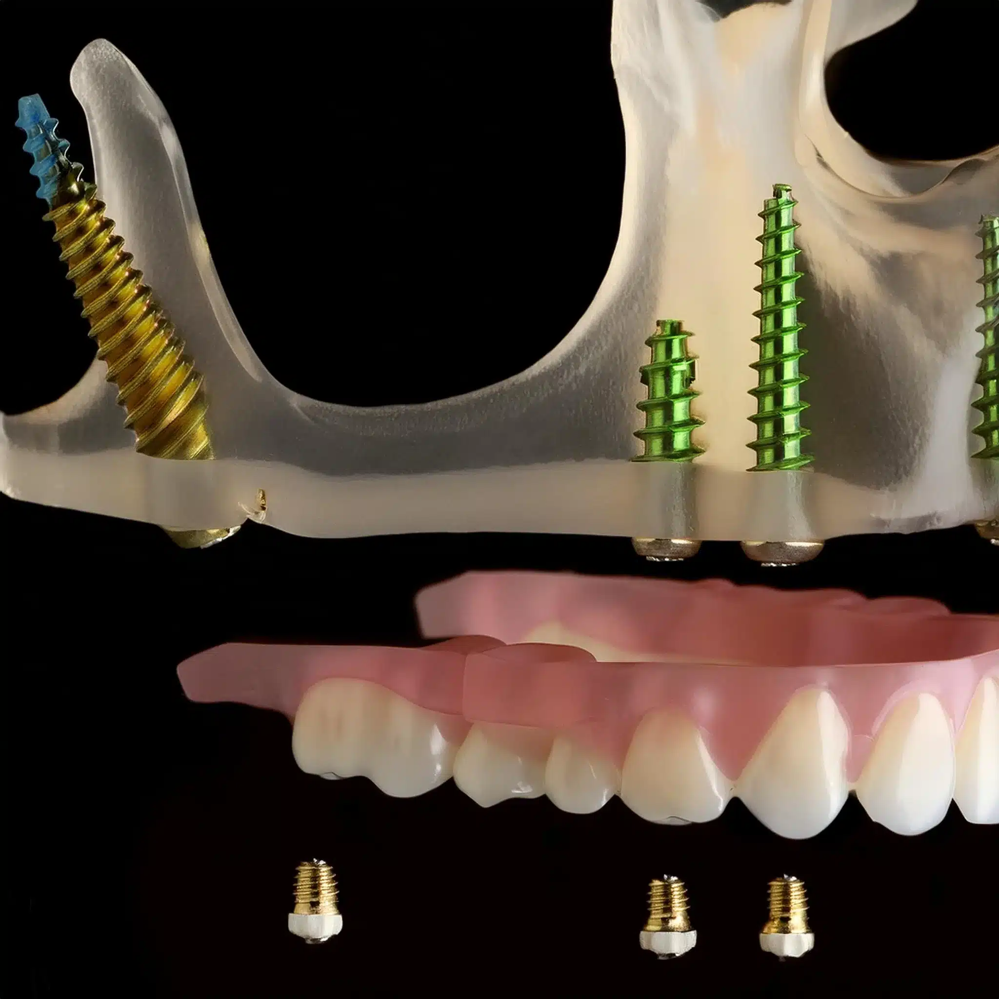 Showing a 3d plan of pterygoid dental implants