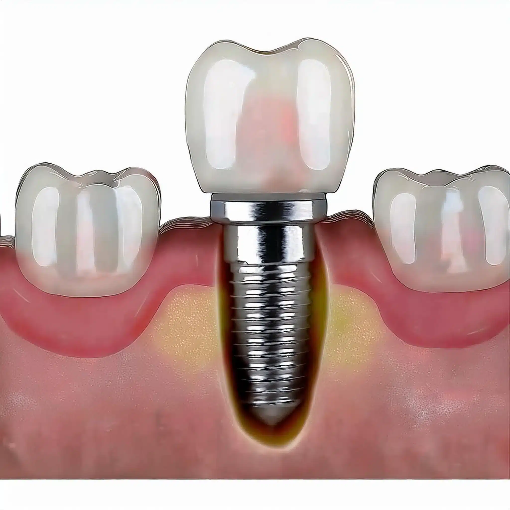 Peri implantitis