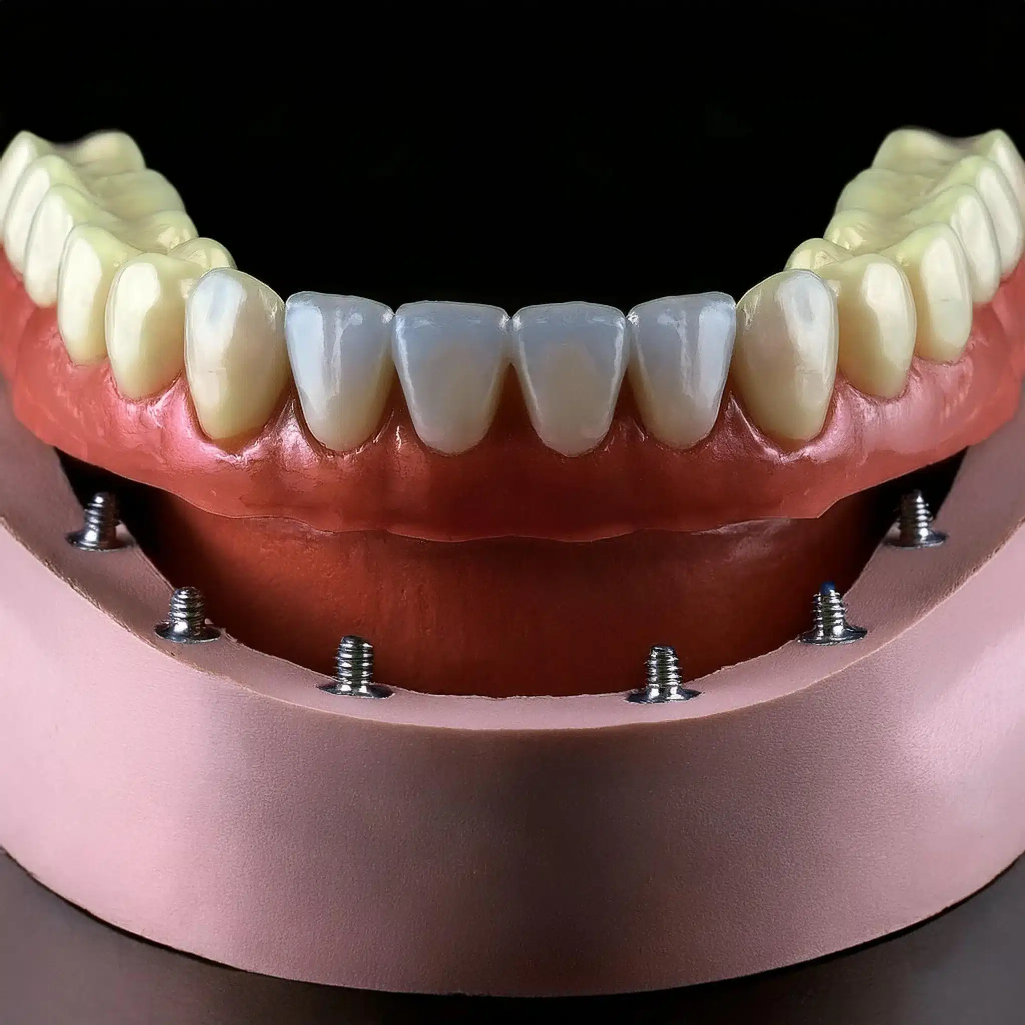 Posizionamento 3D di mini impianti dentali