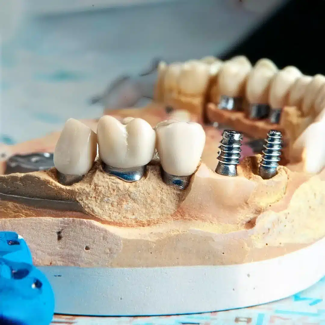 Implantes dentales en un modelo de demostración