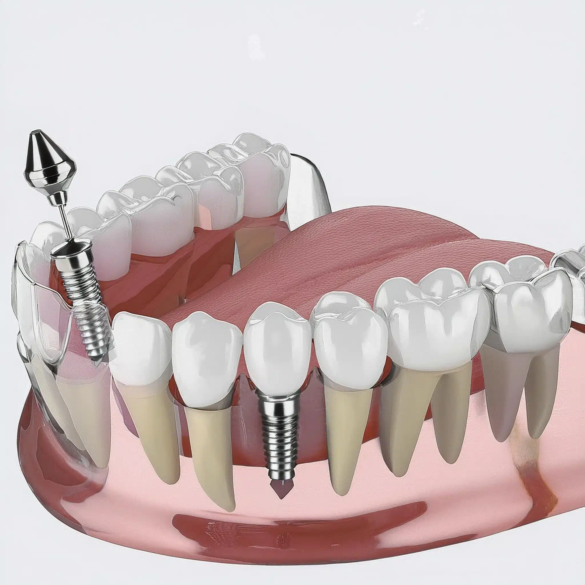 How is a dental implant overdenture placement