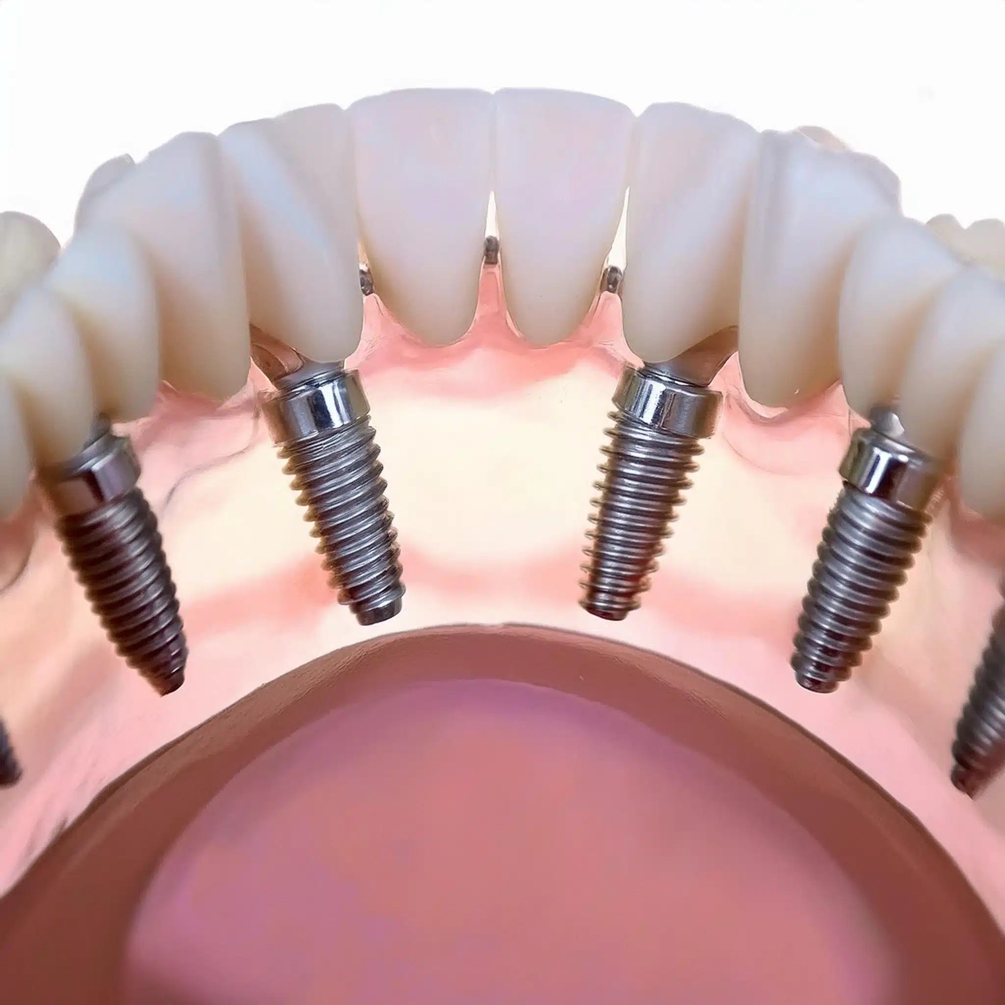 Corone e impianti dentali