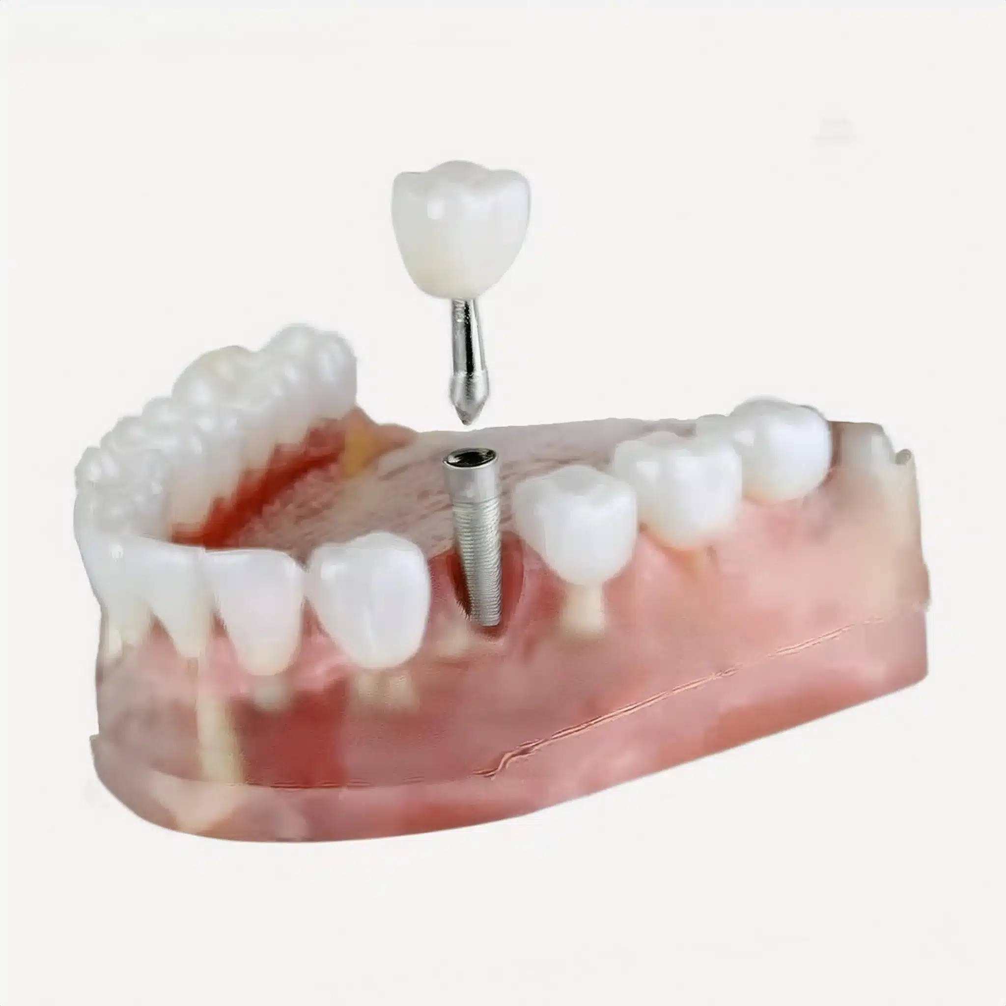 Placement of a dental implant