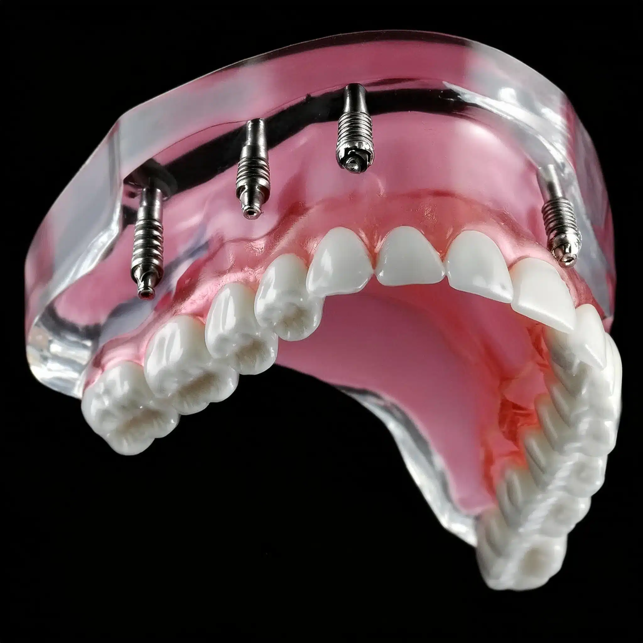 Dental implant overdenture work