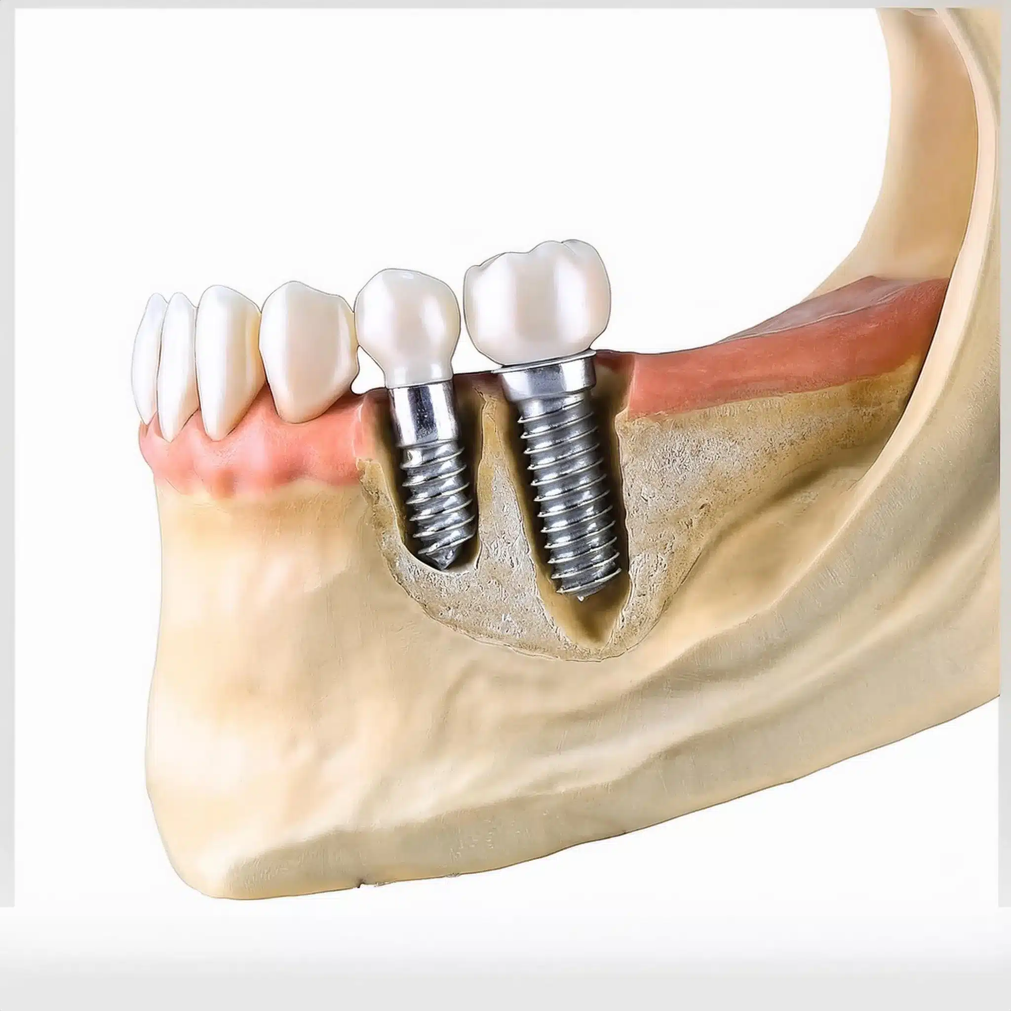 Dental implant  with bone loss