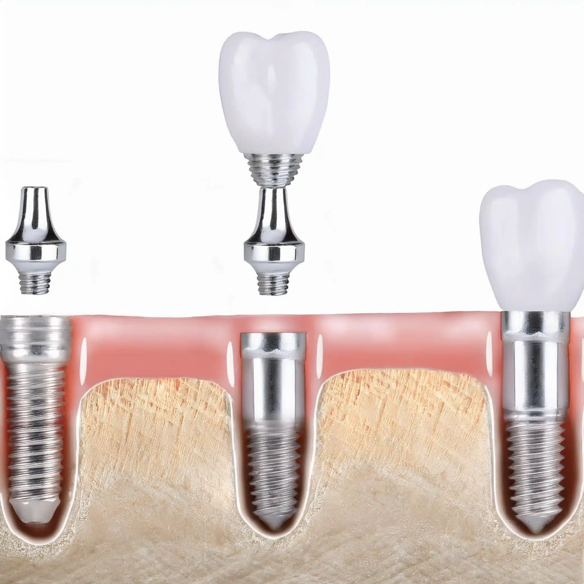 Example how is a dental implant placed