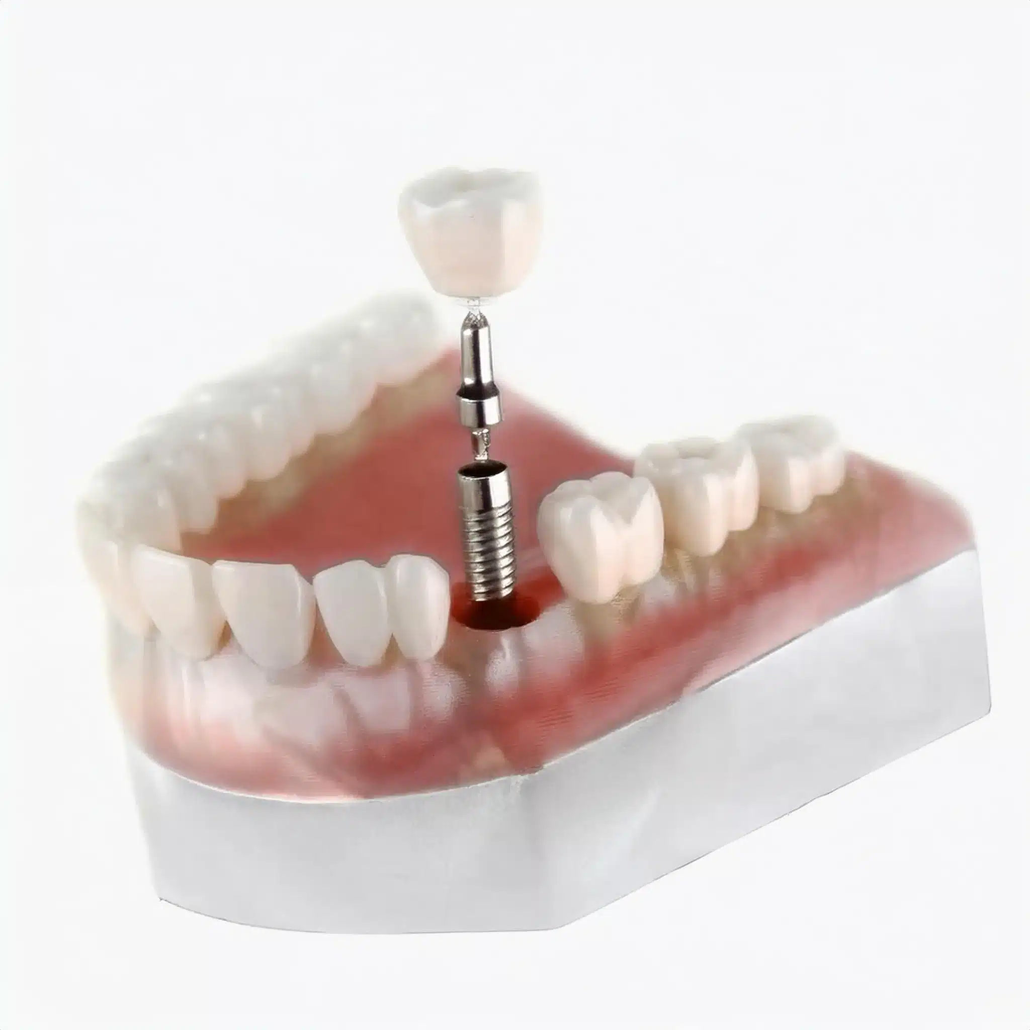 How is placement a transosteal dental implant 