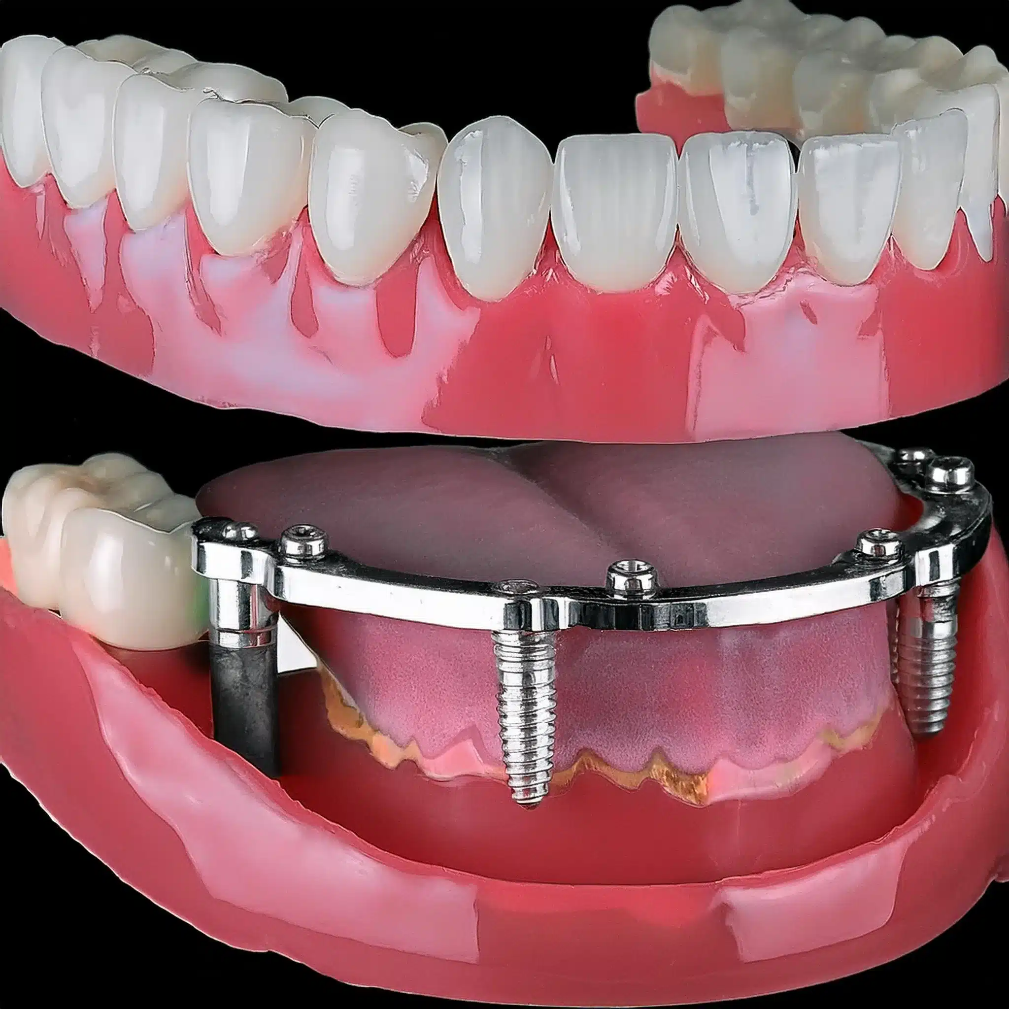 Dental implant overdenture