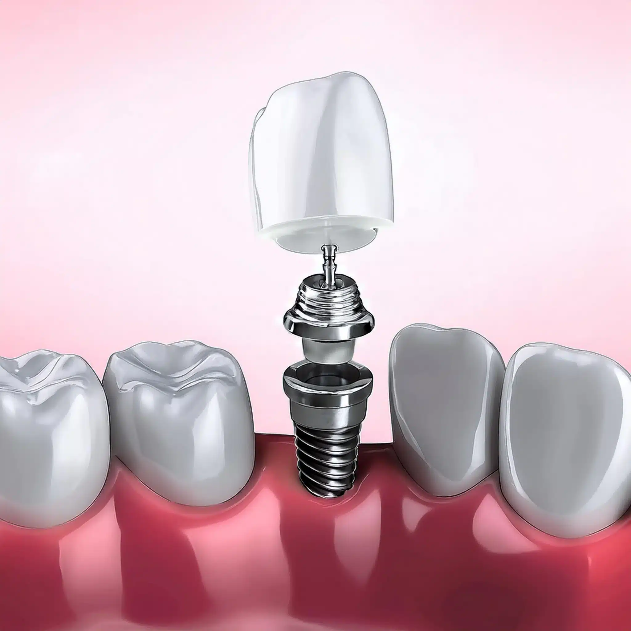 Dental implant repair