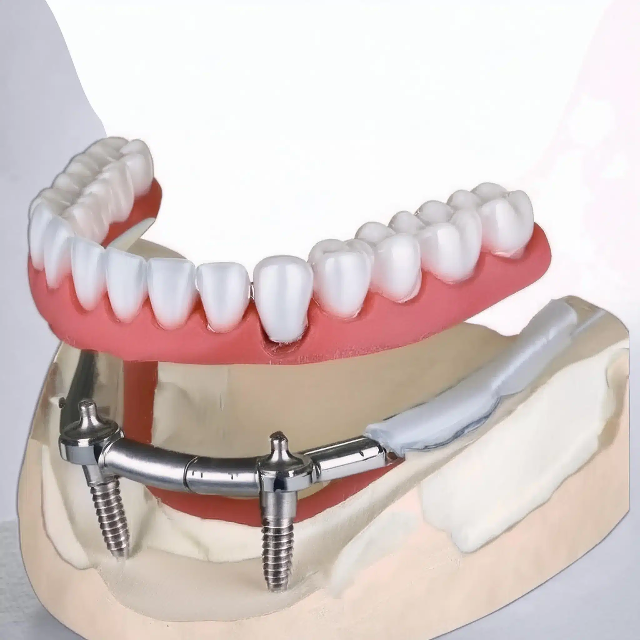 Dental implant overdenture