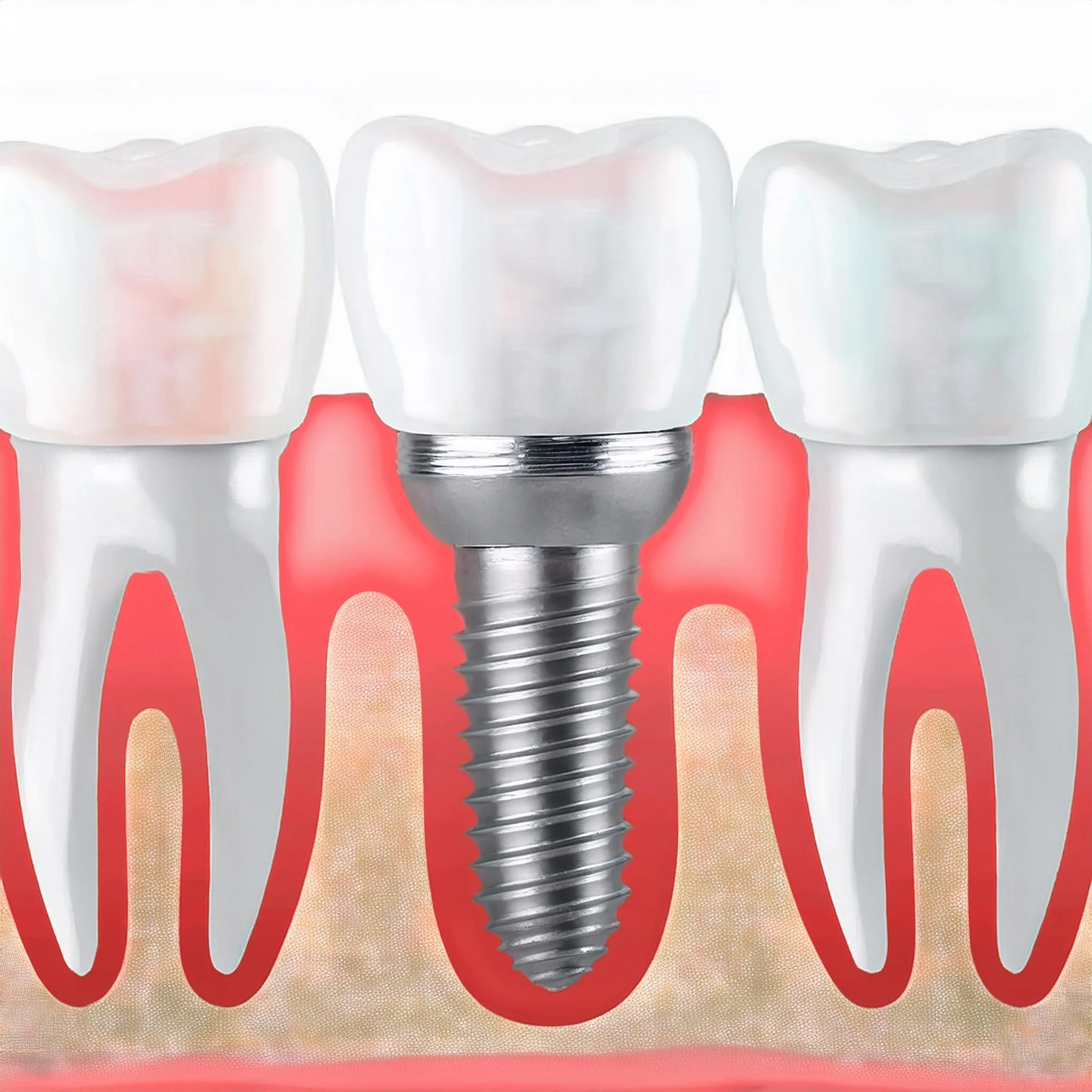 Implantes dentales