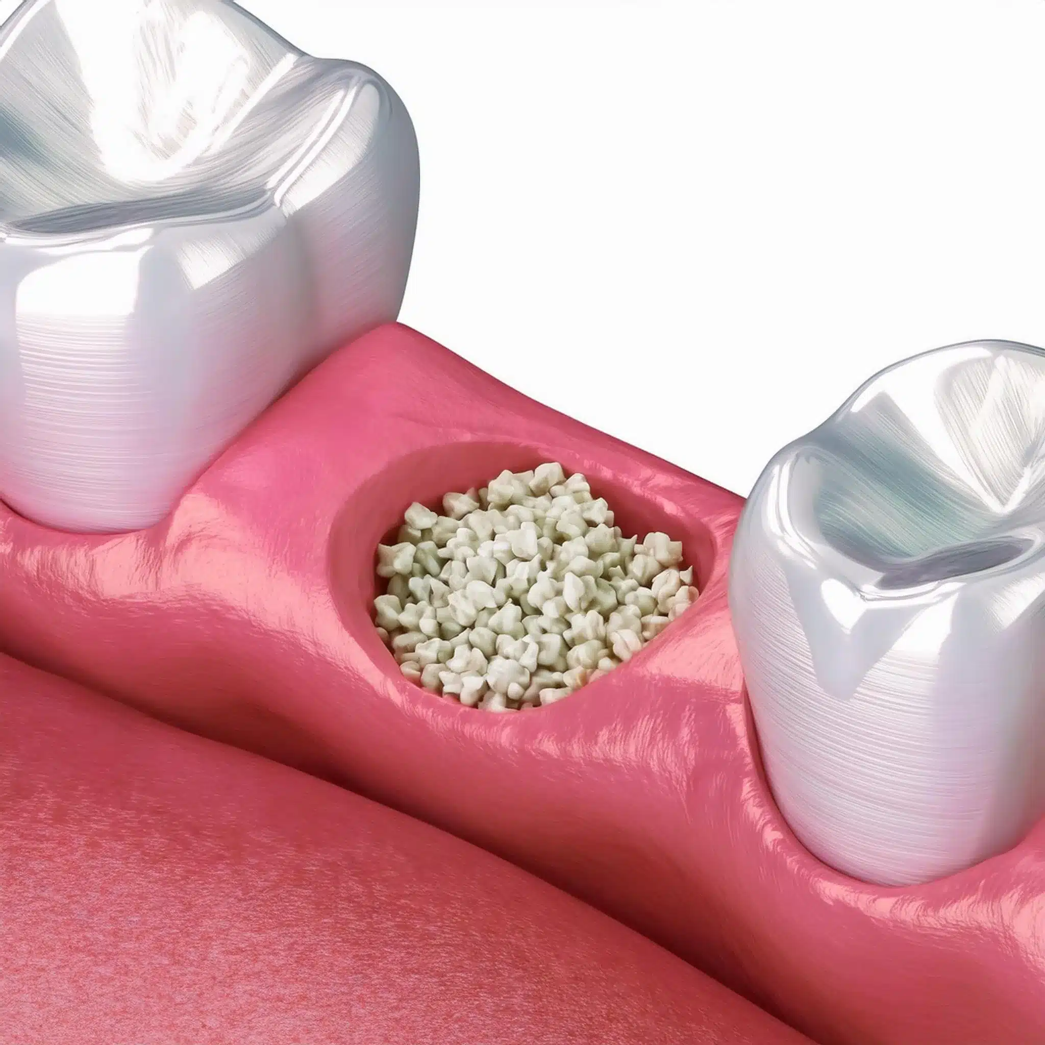 How works a dental implant without bone?