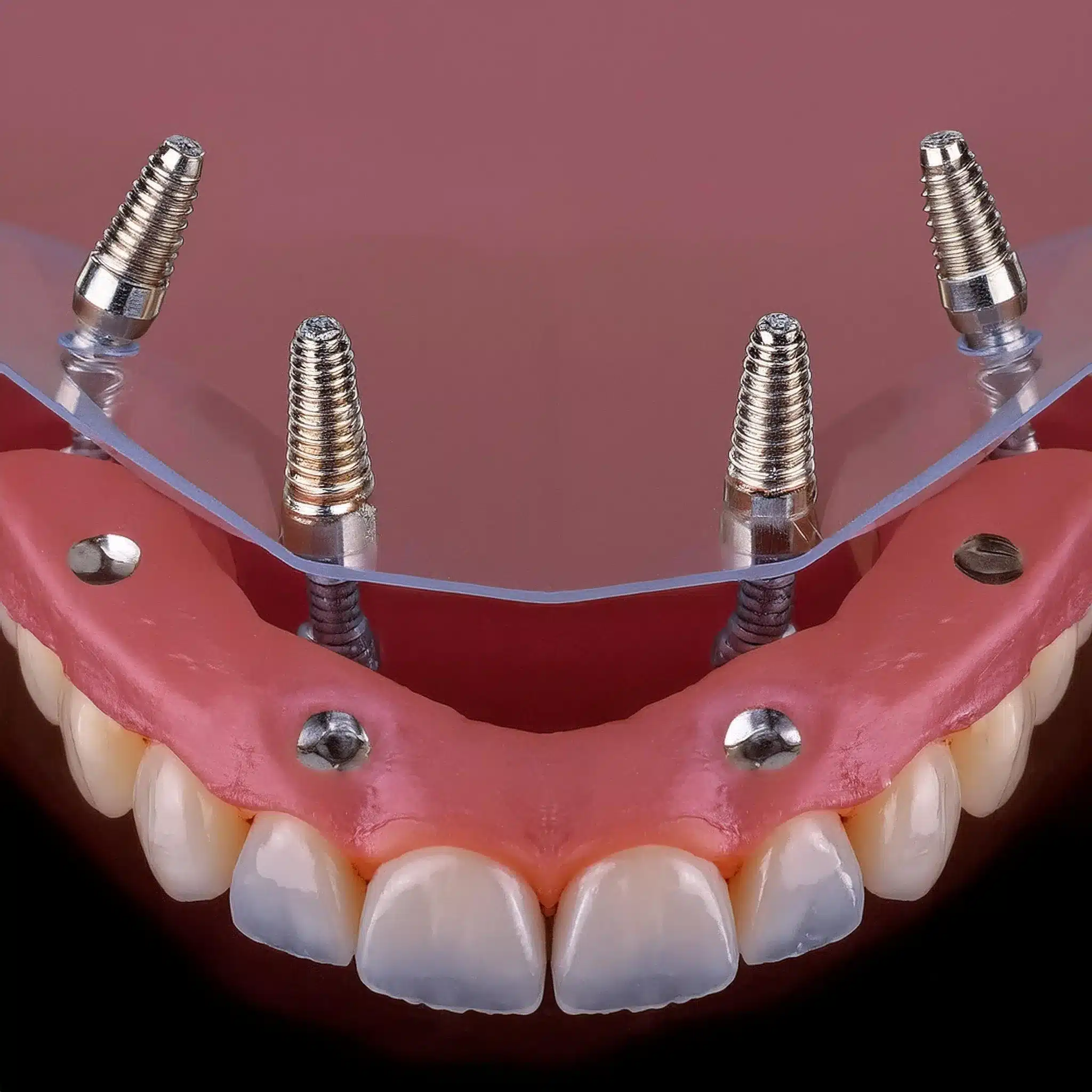 How is placement a full arch dental implants