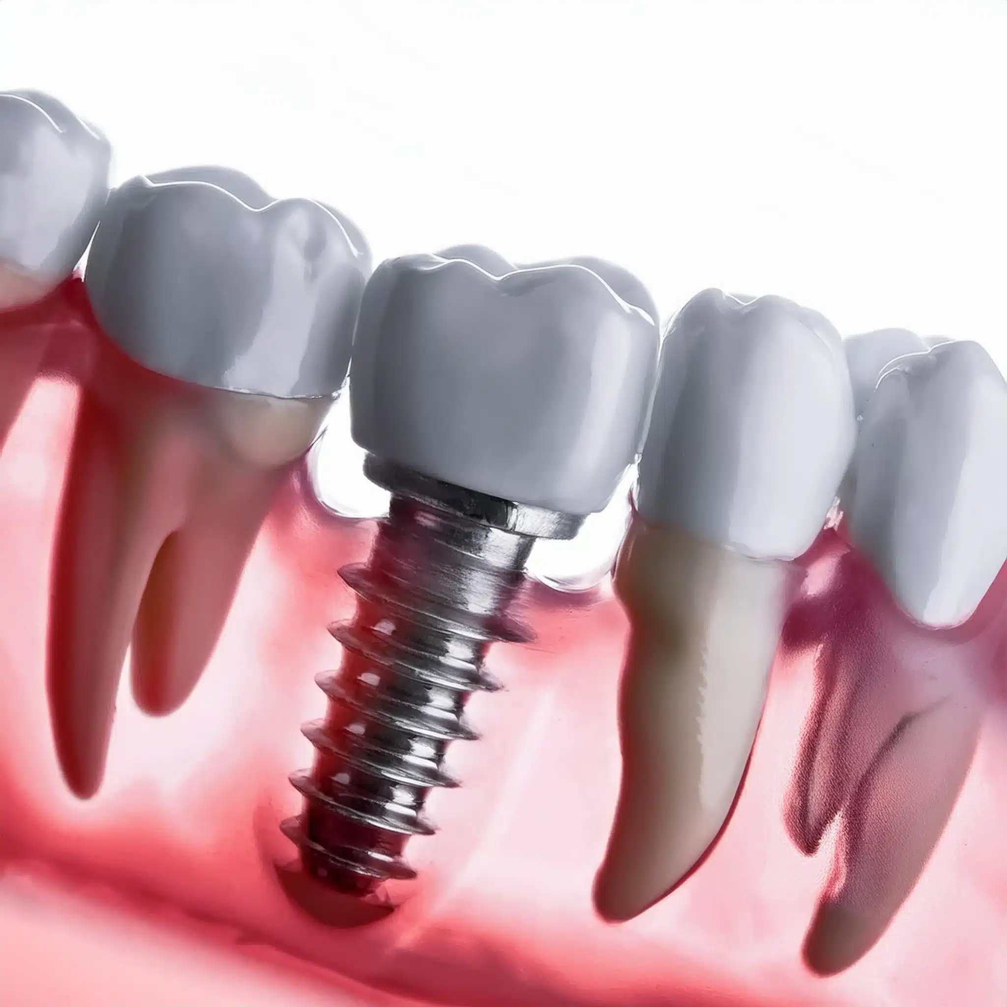 Dental implant placement