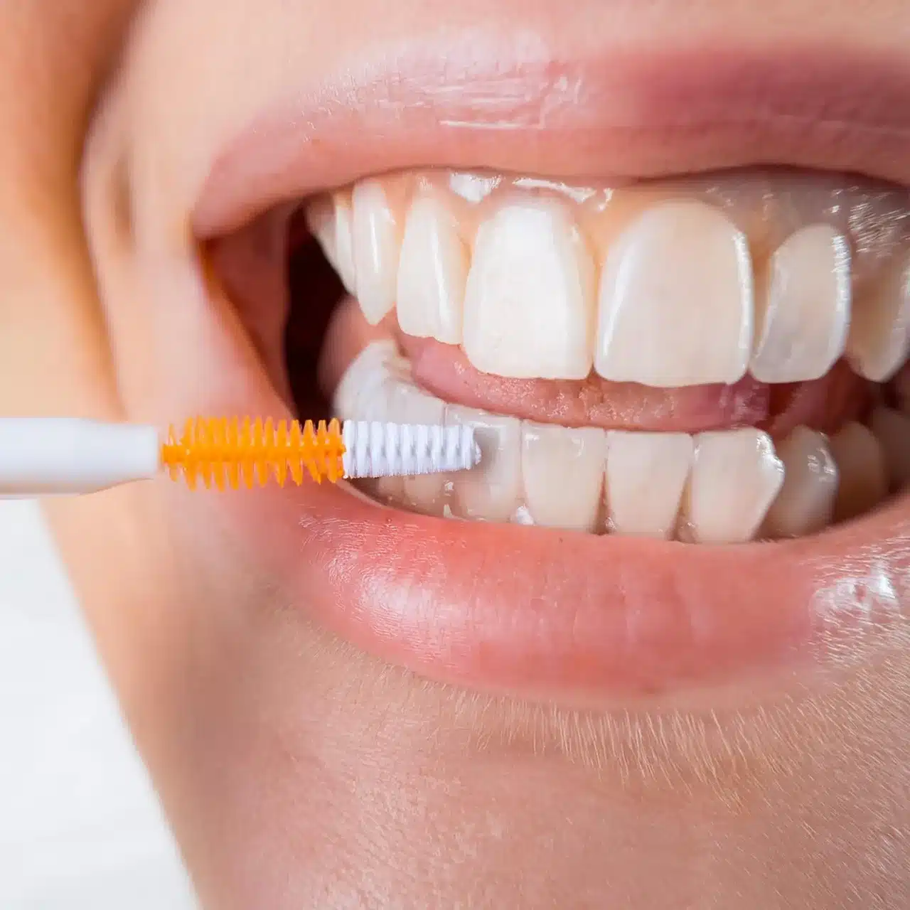 Come prendersi cura degli impianti dentali