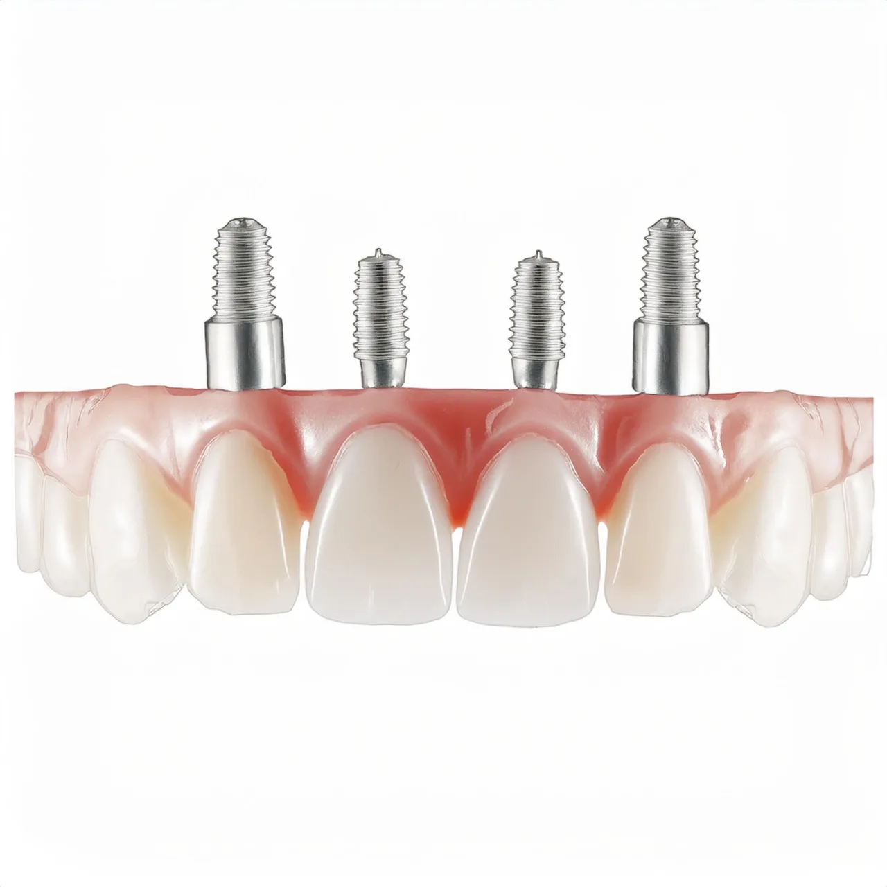 Example of pterygoid dental implants placement