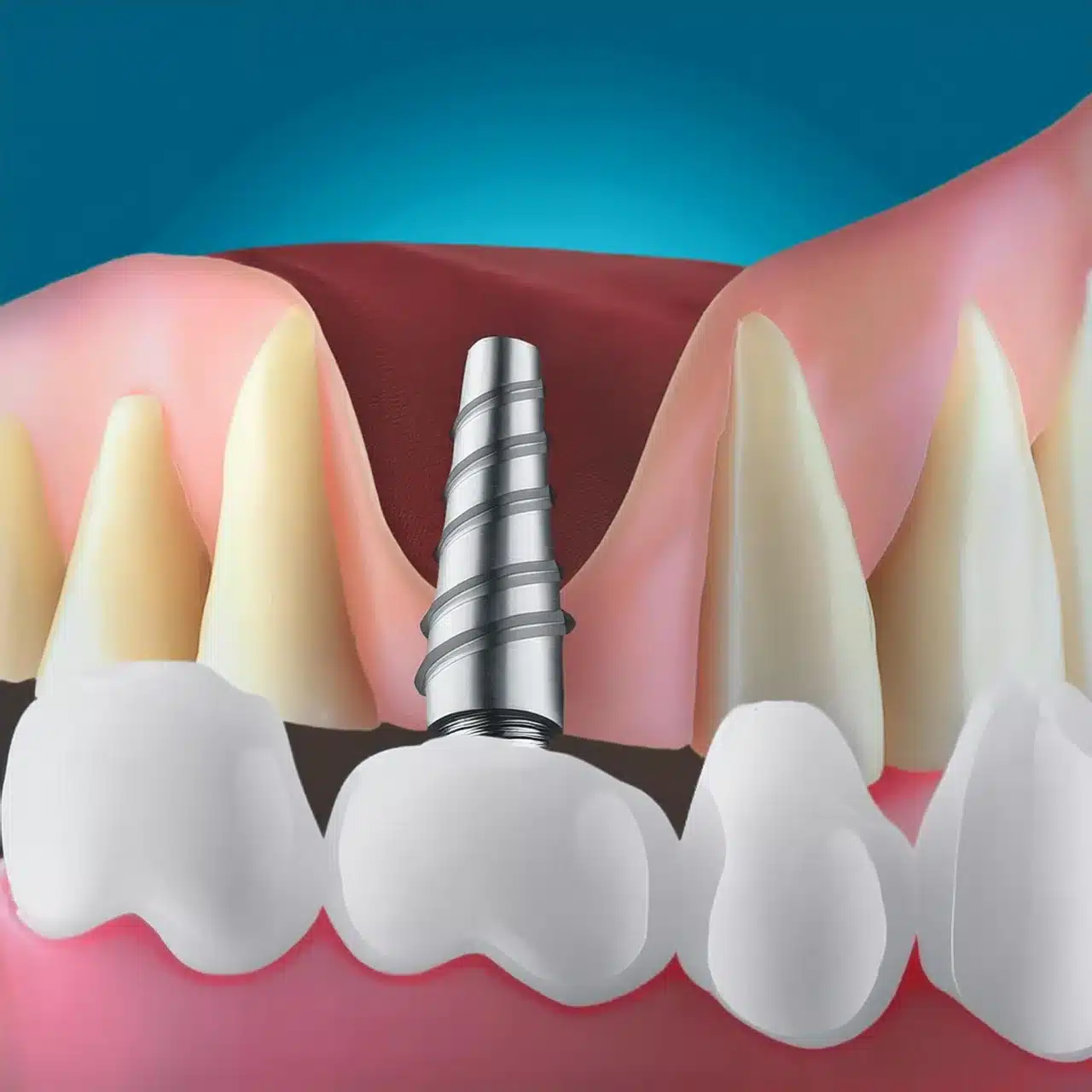 Sinus lift dental implants placement