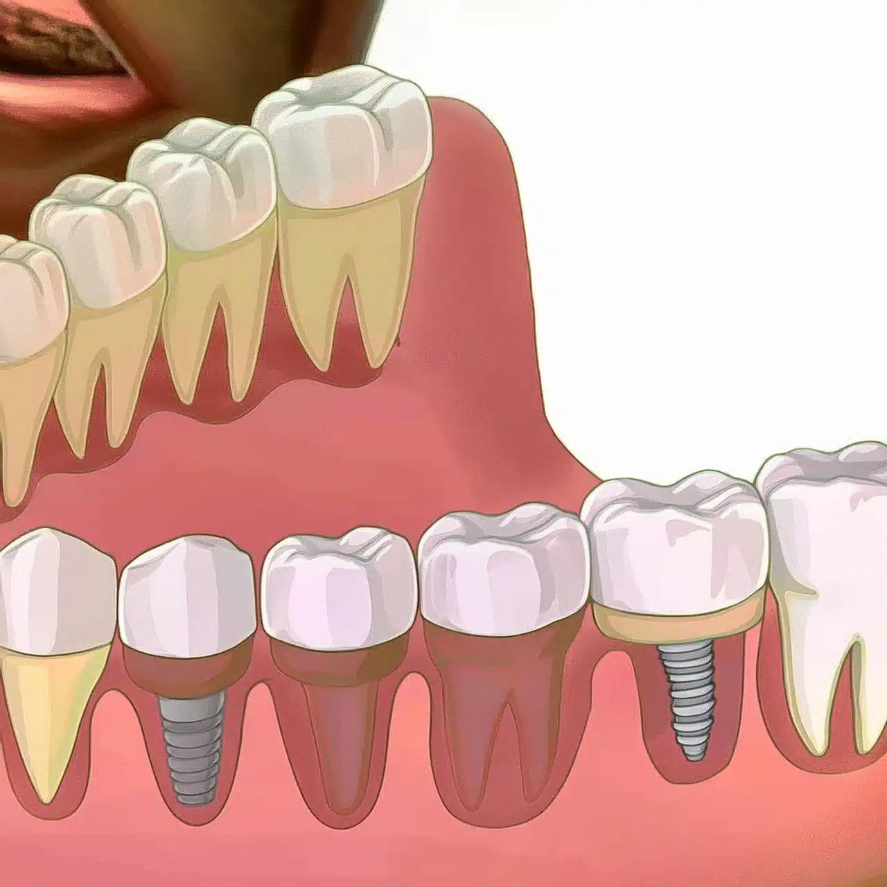 Un piano di impianti dentali con innesto osseo