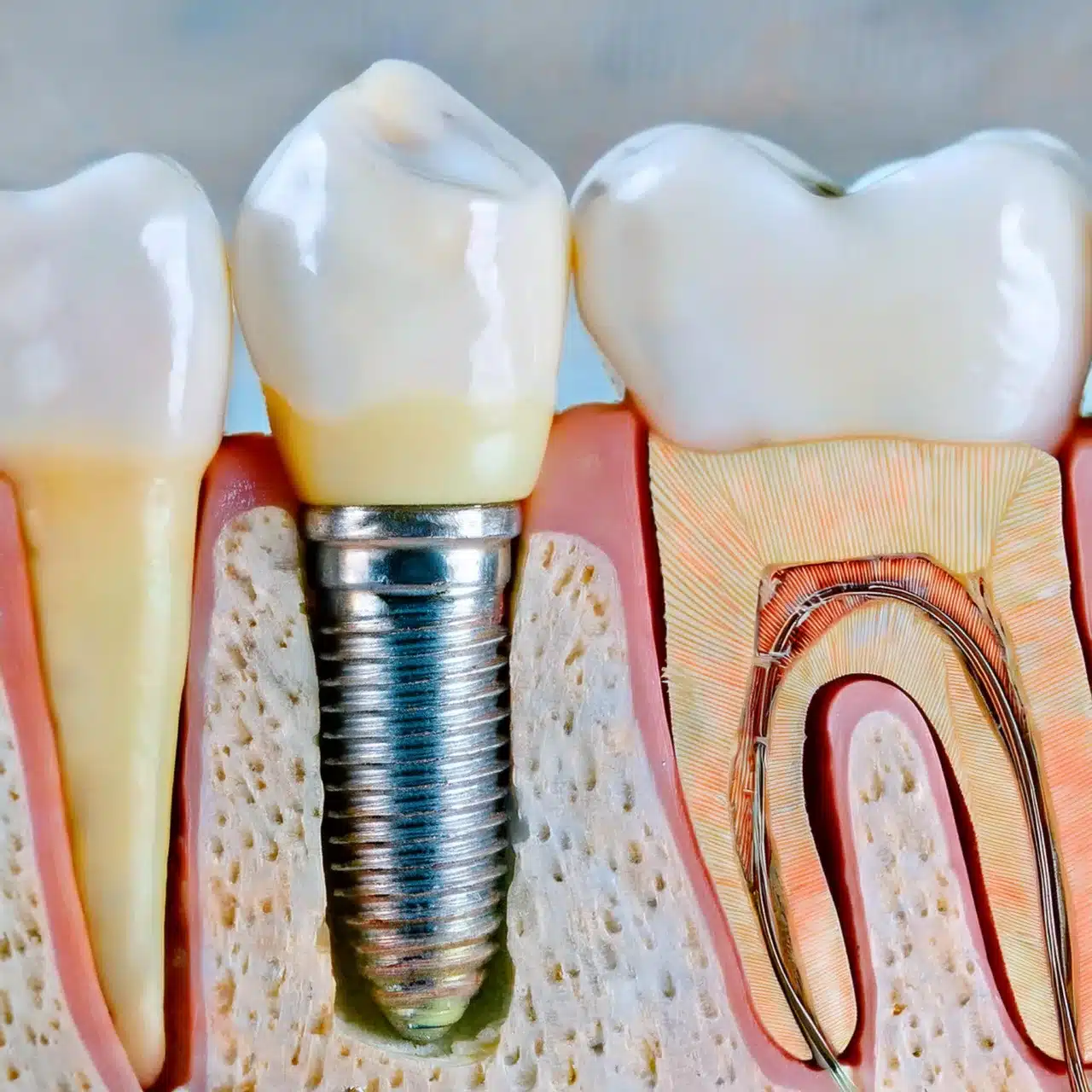 Showing dental implant with bone loss