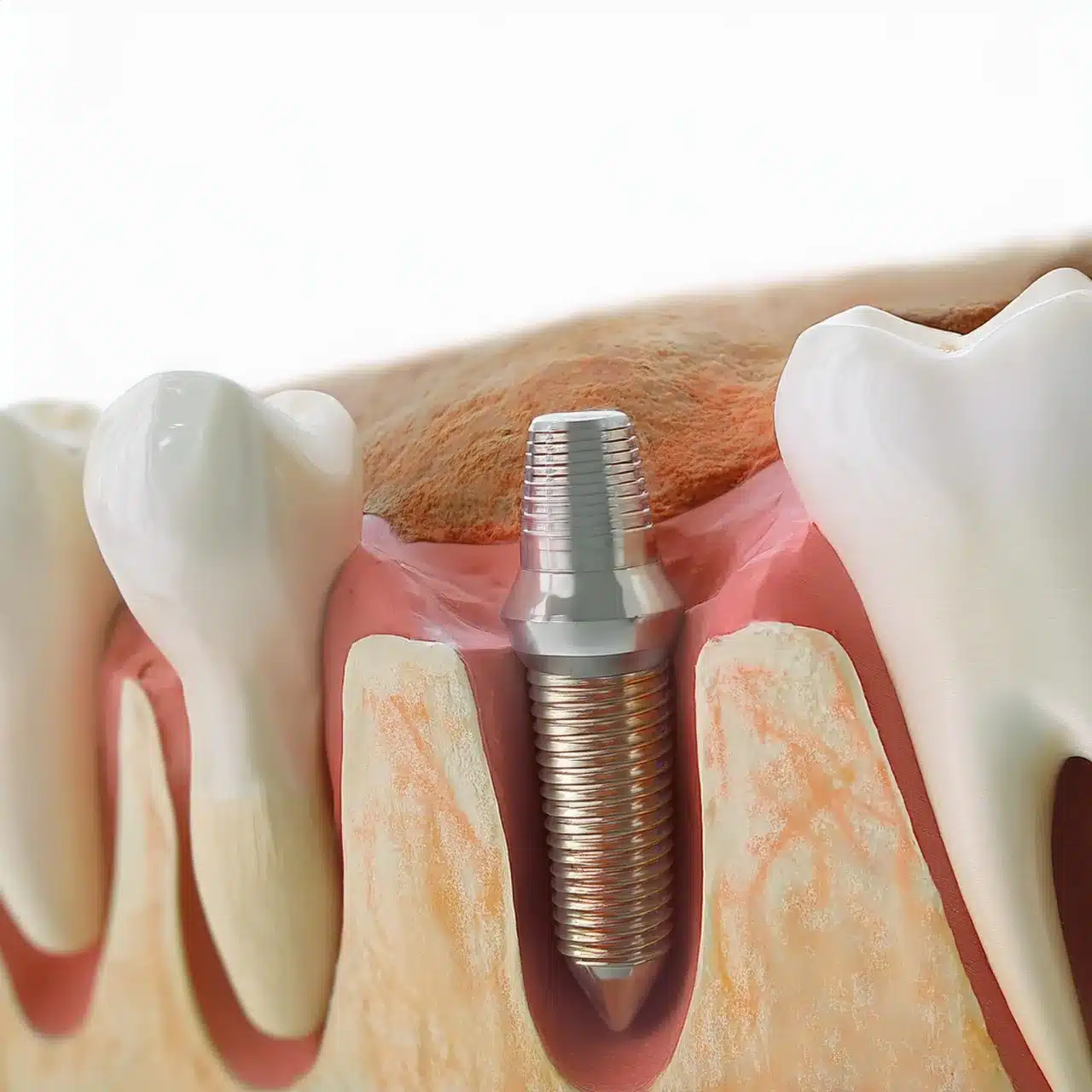 Dental implant placement