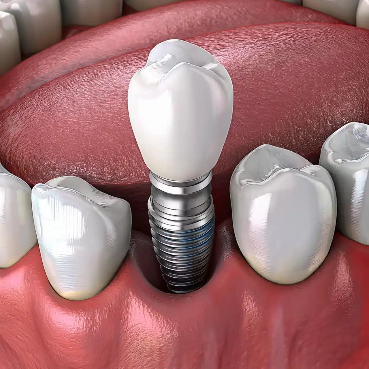 Dental implant