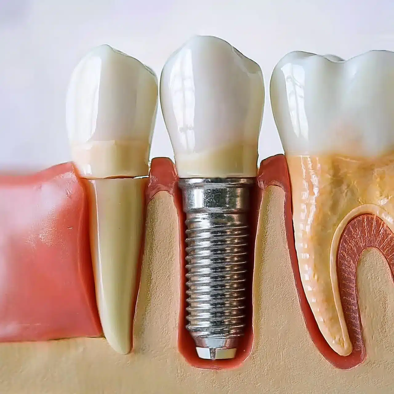 3D plan of dental implant