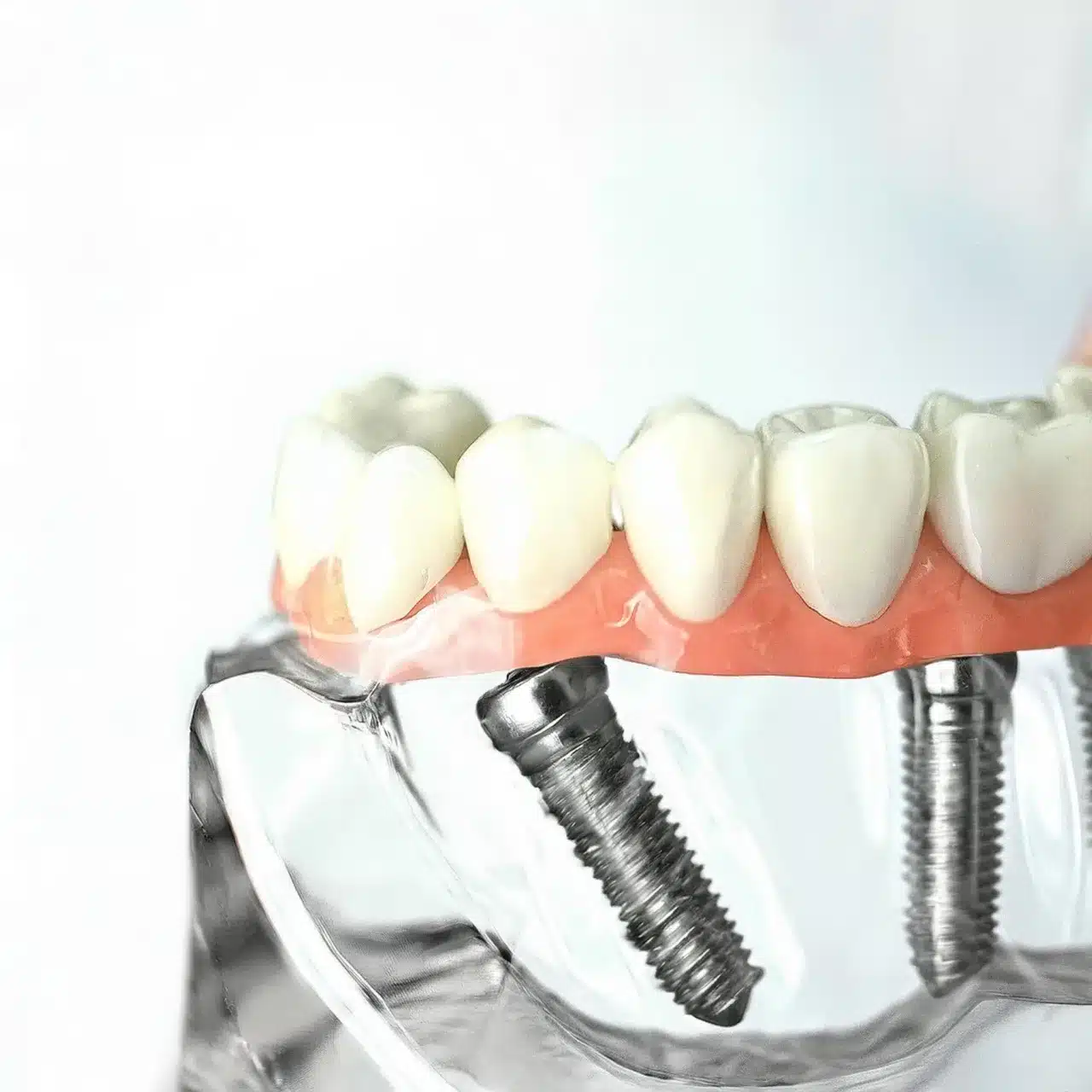 3D plan of a dental implant work