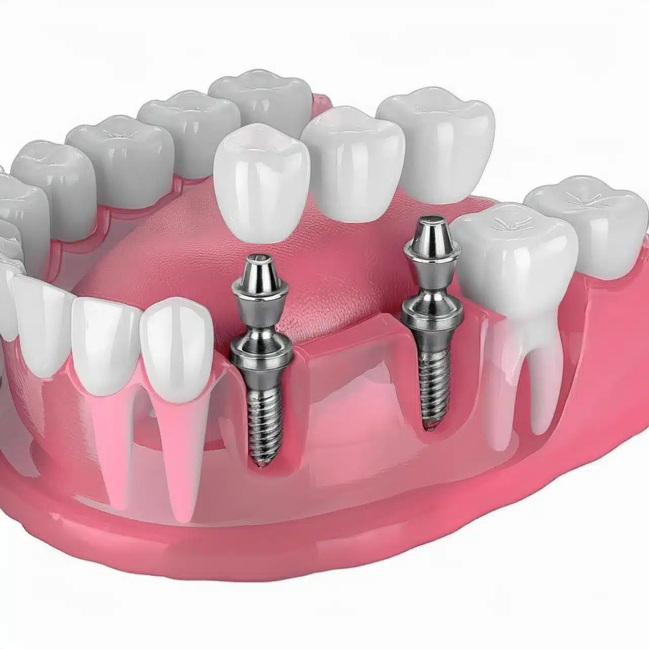 Ponti supportati da impianti dentali