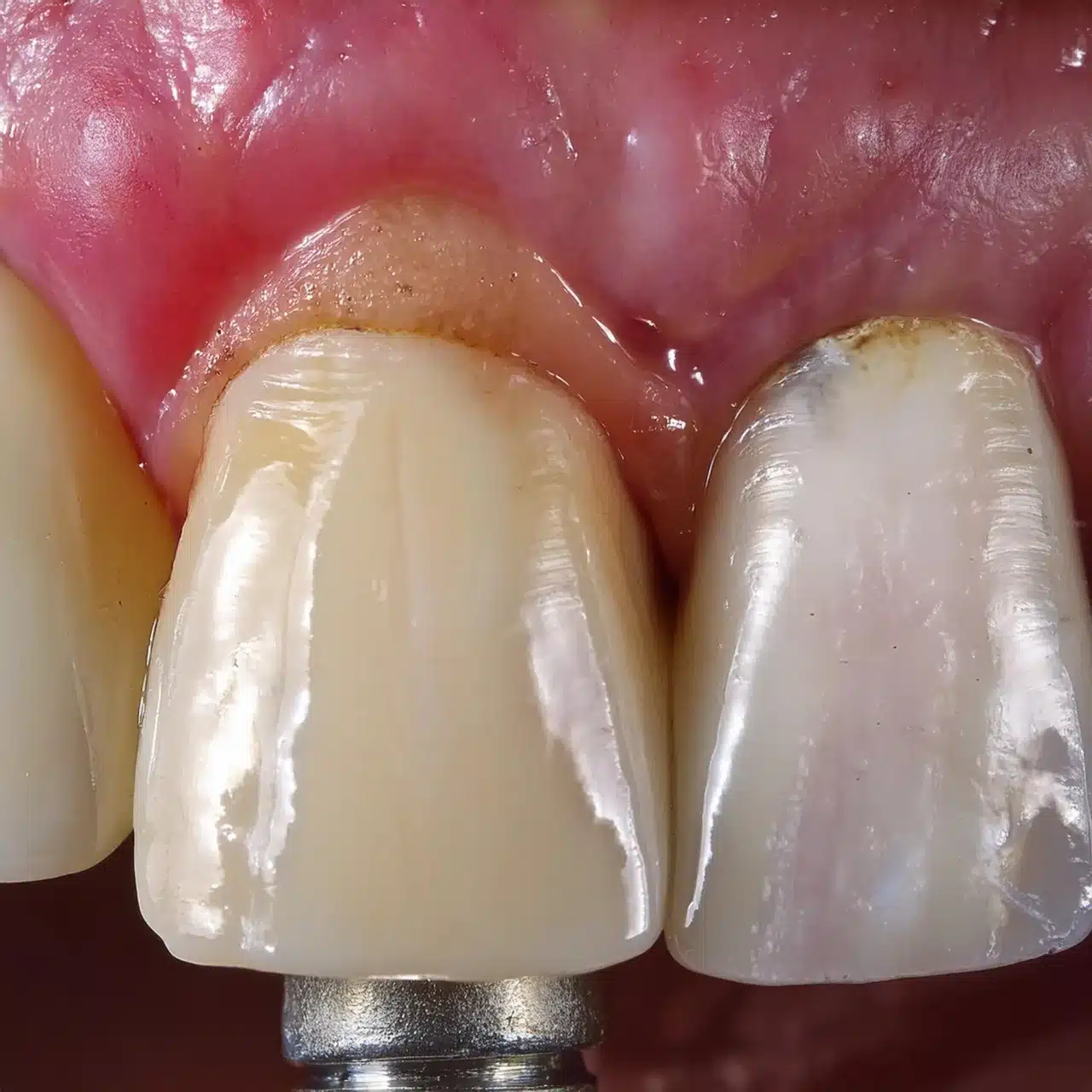 Failed delayed loading dental implant