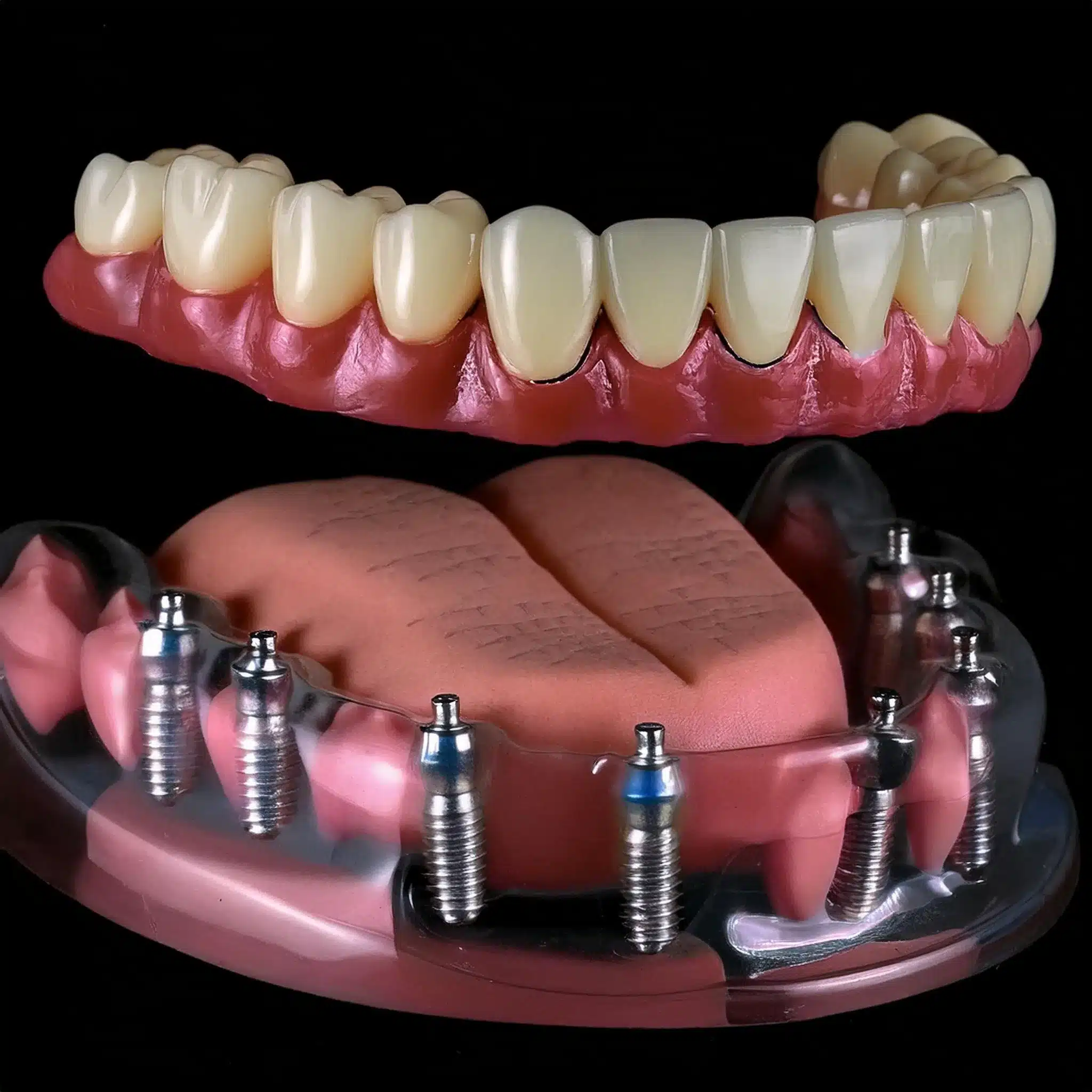 All on 8 dental implants