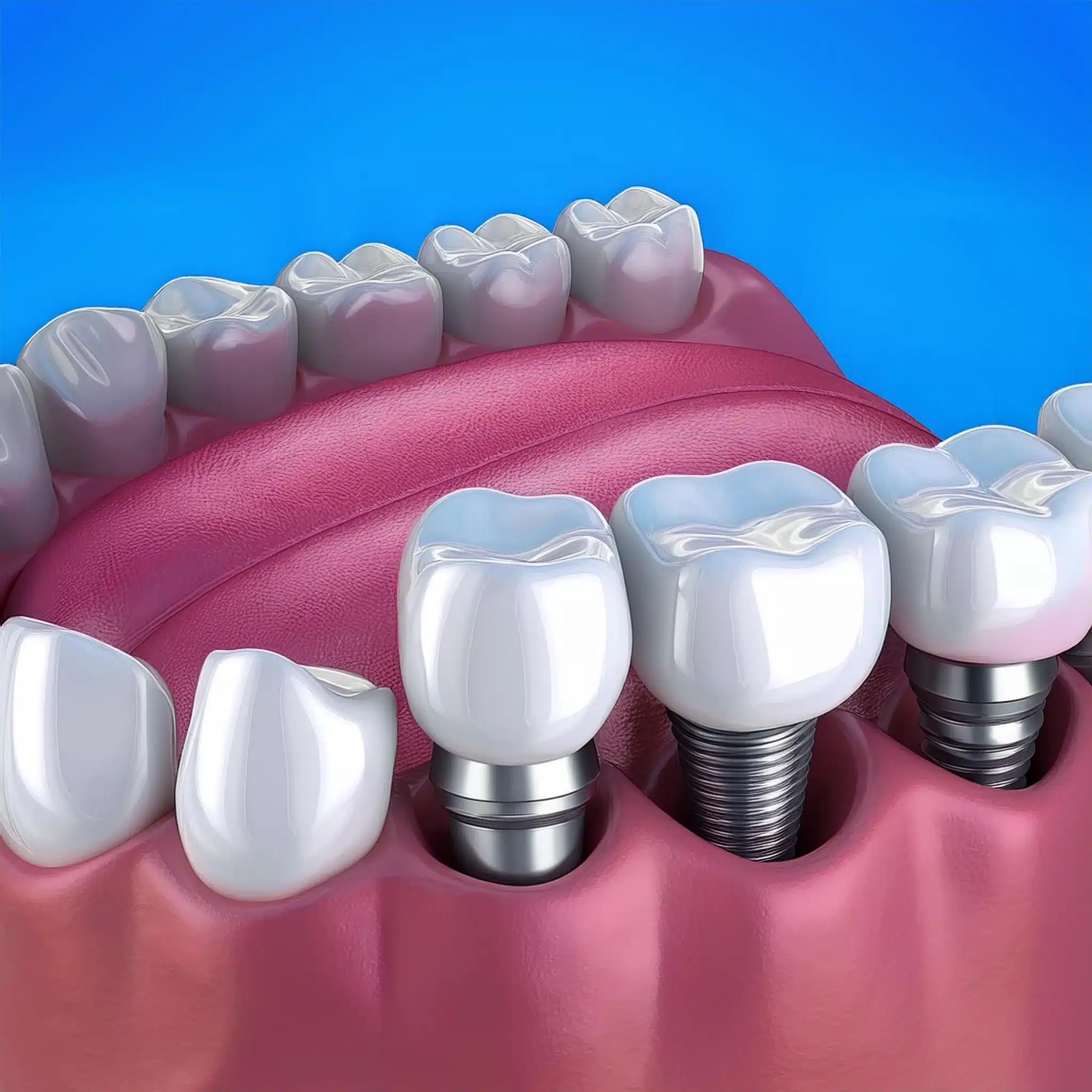 Type of dental implants for multiple teeth