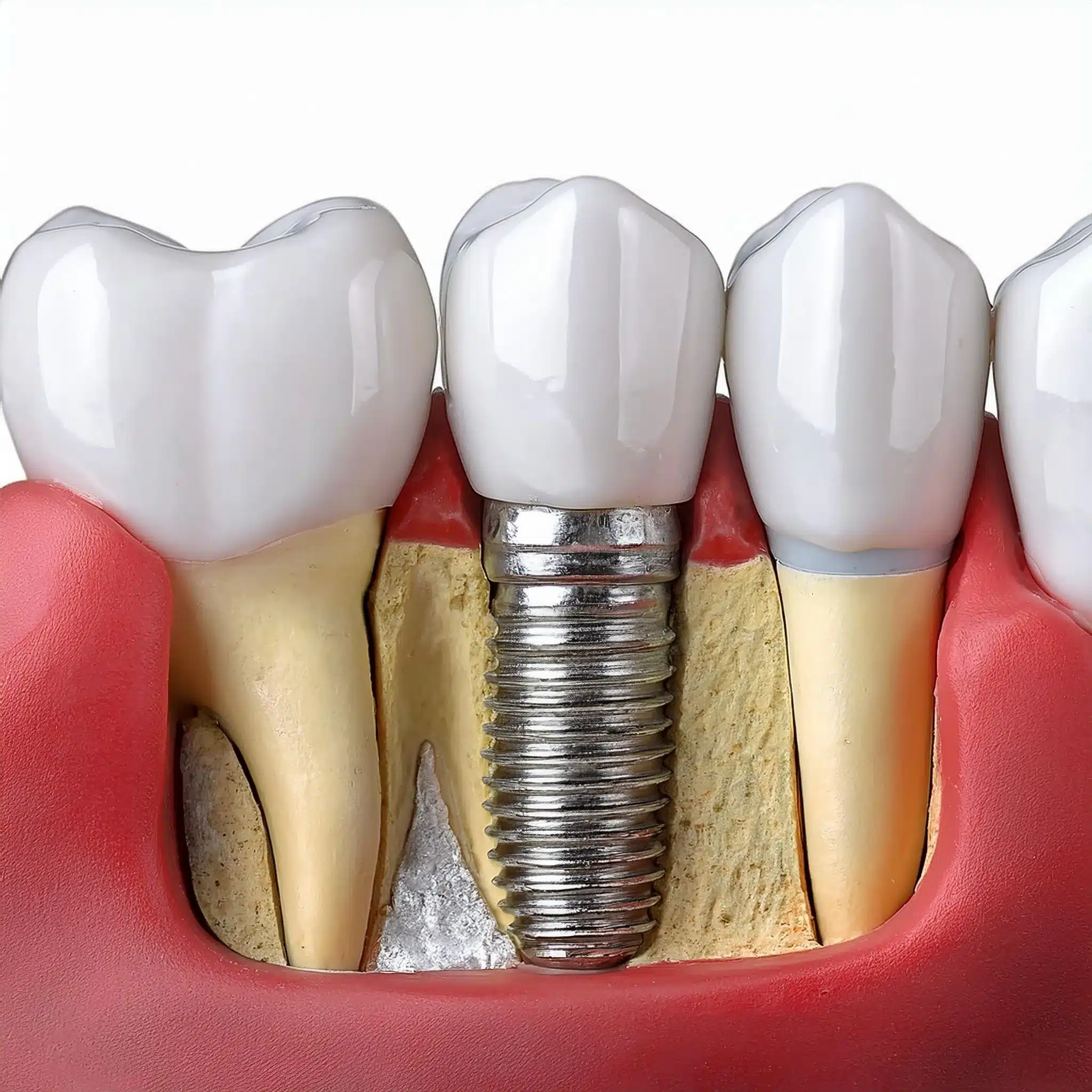 Plan 3D des implants dentaires