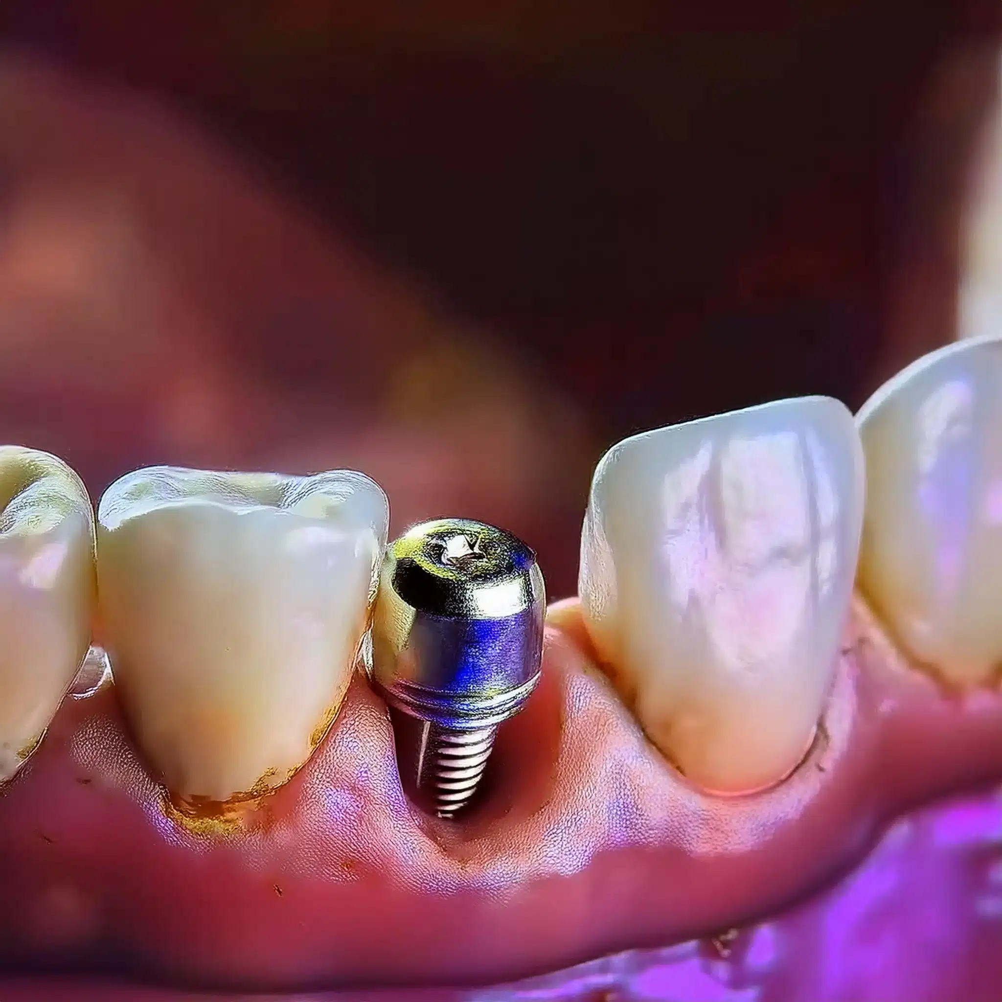 Loose dental implants