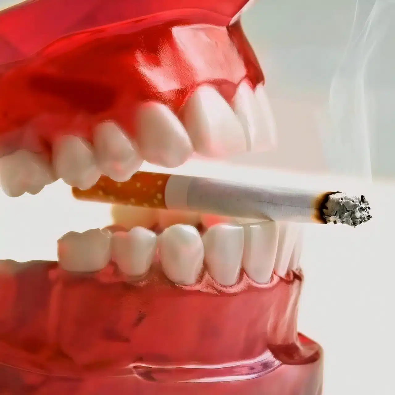 Implants dentaires et tabagisme